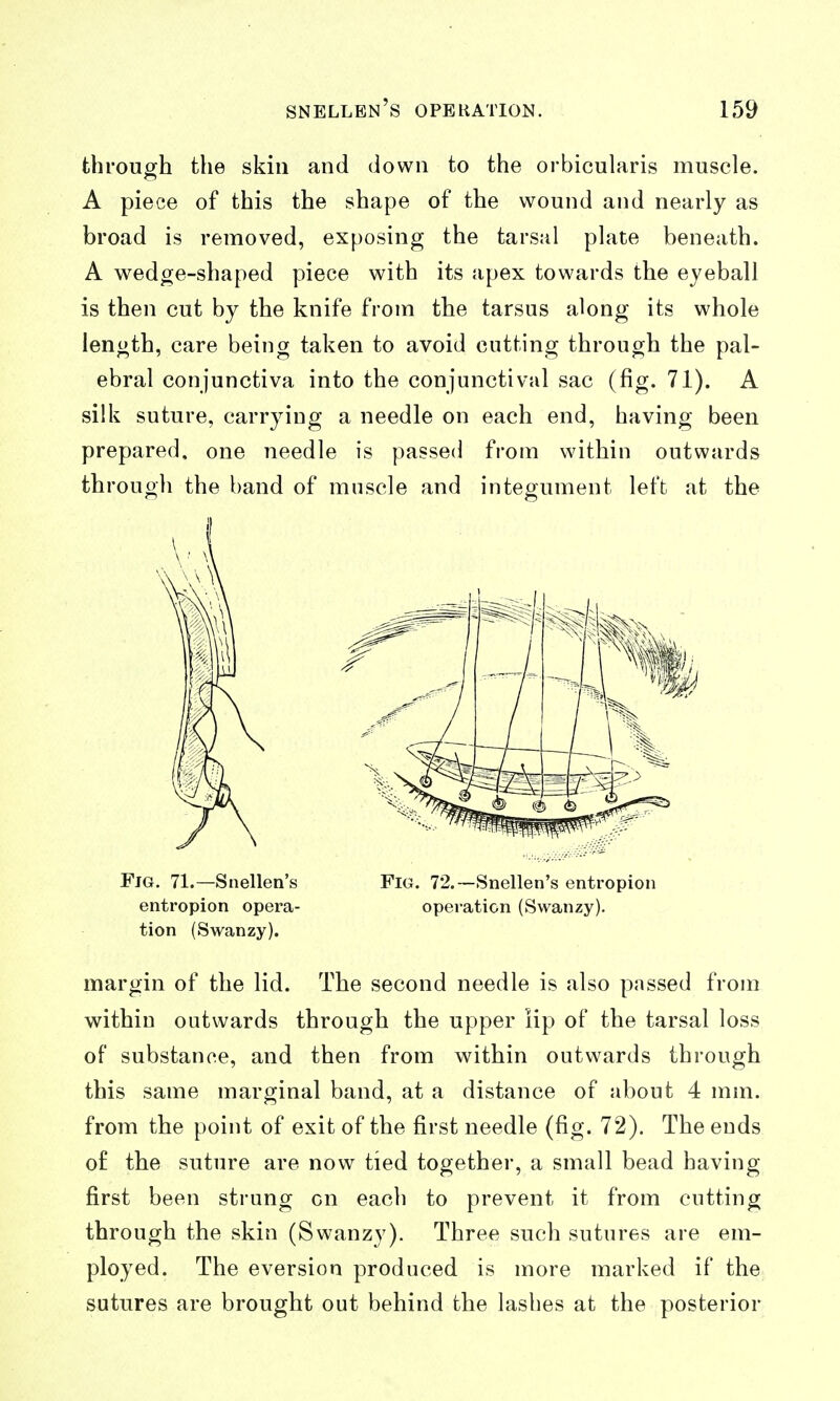 through the skin and down to the orbicularis muscle. A piece of this the shape of the wound and nearly as broad is removed, exposing the tarsal plate beneath. A wedge-shaped piece with its apex towards the eyeball is then cut by the knife from the tarsus along its whole length, care being taken to avoid cutting through the pal- ebral conjunctiva into the conjunctival sac (fig. 71). A silk suture, carrying a needle on each end, having been prepared, one needle is passed from within outwards through the band of muscle and integument left at the Fjg. 71.—Snellen's entropion opera- tion (Swanzy). Fig. 72.—Snellen's entropion operation (Swanzy). margin of the lid. The second needle is also passed from within outwards through the upper lip of the tarsal loss of substance, and then from within outwards through this same marginal band, at a distance of about 4 mm. from the point of exit of the first needle (fig. 72). The ends of the suture are now tied together, a small bead having first been strung on each to prevent it from cutting through the skin (Swanzy). Three such sutures are em- ployed. The eversion produced is more marked if the sutures are brought out behind the lashes at the posterior