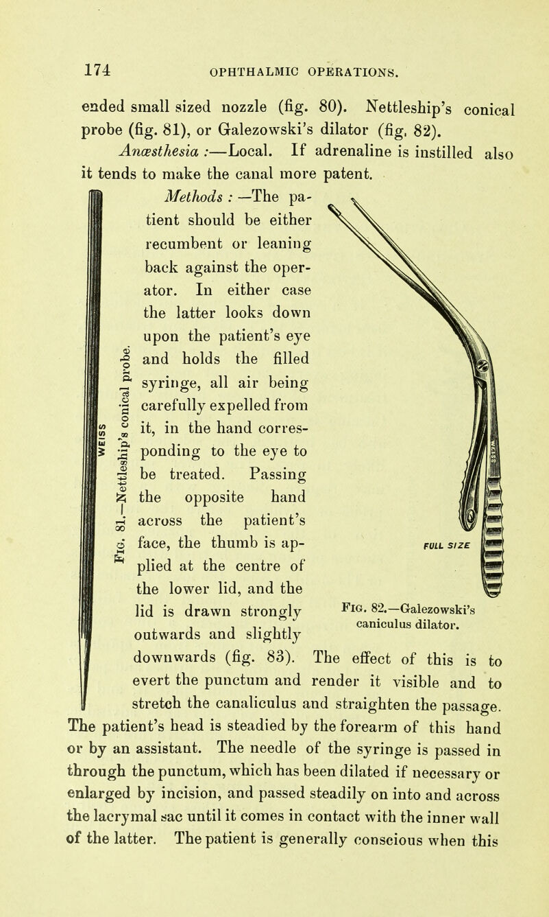 ended small sized nozzle (fig. 80). Nettleship's conical probe (fig. 81), or Galezowski's dilator (fig, 82). Ancesthesia :—Local. If adrenaline is instilled also it tends to make the canal more patent. Methods : —The pa- tient should be either recumbent or leaning back against the oper- ator. In either case the latter looks down upon the patient's eye and holds the filled syringe, all air being carefully expelled from it, in the hand corres- ponding to the eye to be treated. Passing the opposite hand across the patient's face, the thumb is ap- plied at the centre of the lower lid, and the lid is drawn strongly outwards and slightly downwards (fig. 83). evert the punctum and stretch the canaliculus and straighten the passage. The patient's head is steadied by the forearm of this hand or by an assistant. The needle of the syringe is passed in through the punctum, which has been dilated if necessary or enlarged by incision, and passed steadily on into and across the lacrymal sac until it comes in contact with the inner wall of the latter. The patient is generally conscious when this 15 FOIL SIZE Fig. 82.—Galezowski's caniculus dilator. The eflPect of this is render it visible and to to
