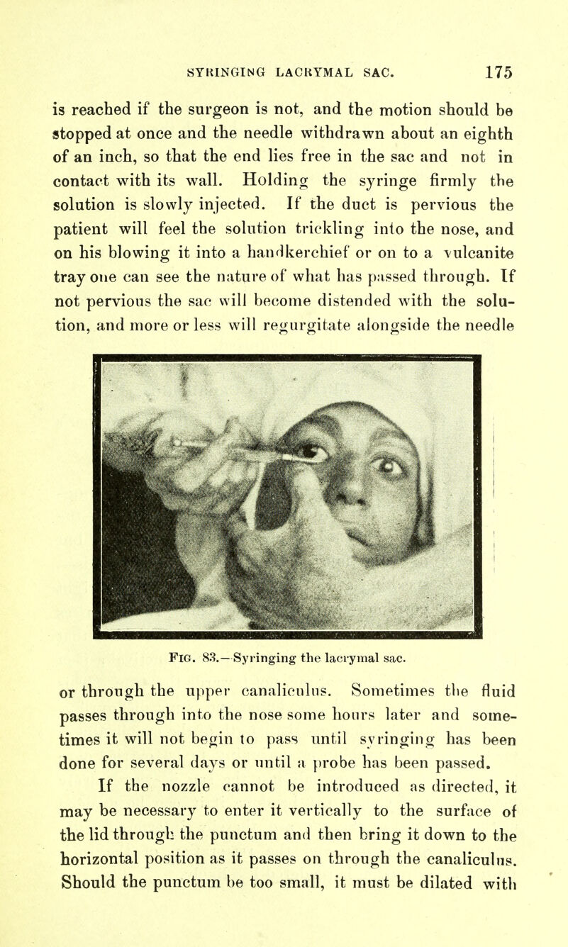 is reached if the surgeon is not, and the motion should be stopped at once and the needle withdrawn about an eighth of an inch, so that the end lies free in the sac and not in contact with its wall. Holding the syringe firmly the solution is slowly injected. If the duct is pervious the patient will feel the solution trickling into the nose, and on his blowing it into a handkerchief or on to a vulcanite tray one can see the nature of what has passed through. If not pervious the sac will become distended with the solu- tion, and more or less will regurgitate alongside the needle 4 Fig. 83.—Syringing the laci-ymal sac. or through the upper canaliculus. Sometimes tlie fluid passes through into the nose some hours later and some- times it will not begin to pass until syringing has been done for several days or until a })robe has been passed. If the nozzle cannot be introduced as directed, it may be necessary to enter it vertically to the surface of the lid through the punctum and then bring it down to the horizontal position as it passes on through the canaliculus. Should the punctum be too small, it must be dilated with
