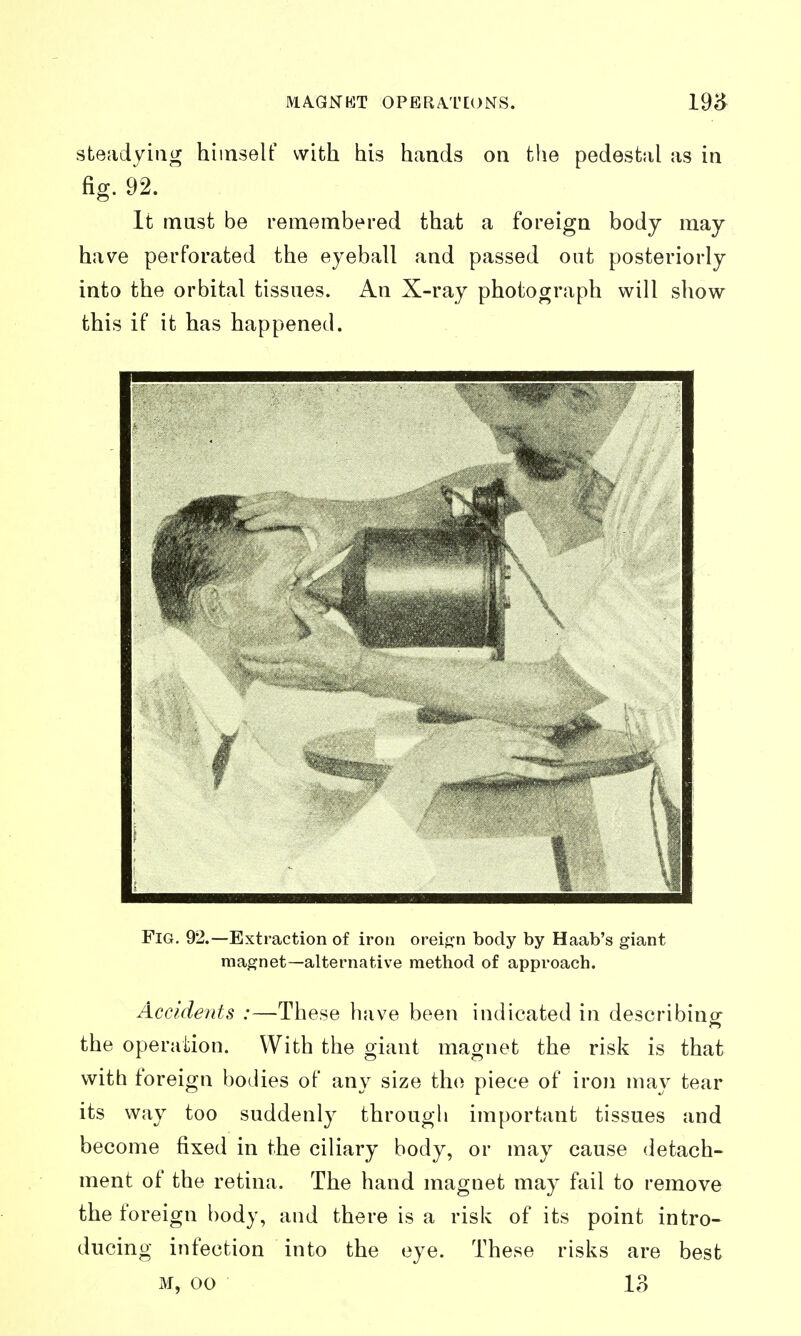 MA.GNKT OPERA.T[()NS. steadying himself with his hands on the pedestal as in fig. 92. It must be remembered that a foreign body may have perforated the eyeball and passed out posteriorly into the orbital tissues. An X-ray photograph will show this if it has happened. Fig. 92.—Extraction of iron orei^n body by Haab's giant magnet—alternative method of approach. Accidents :—These have been indicated in describing the operation. With the giant magnet the risk is that with foreign bodies of any size the piece of iron may tear its way too suddenly through important tissues and become fixed in the ciliary body, or may cause detach- ment of the retina. The hand magnet may fail to remove the foreign body, and there is a risk of its point intro- ducing infection into the eye. These risks are best M, 00 13