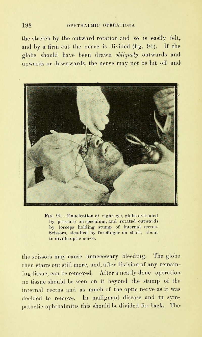the stretch by the outward rotation and so is easily felt,, and by a firm cut the nerve is divided (fig. 94). If the globe should have been drawn ohliquely outwards and upwards or downwards, the nerve may not be hit off and Fig. 94.—Finucleation of right eye, globe extruded by pressure on speculum, and rotated outwards by forceps holding stump of internal rectus. Scissors, steadied by forefinger on shaft, about to divide optic nerve. the scissors may cause unnecessary bleeding. The globe then starts out still more, and, after division of any remain- ing tissue, can be removed. After a neatly done operation no tissue should be seen on it beyond the stump of the internal rectus and as much of the optic nerve as it was decided to remove. In malignant disease and in sym- pathetic ophthalmitis this should be divided far back. The