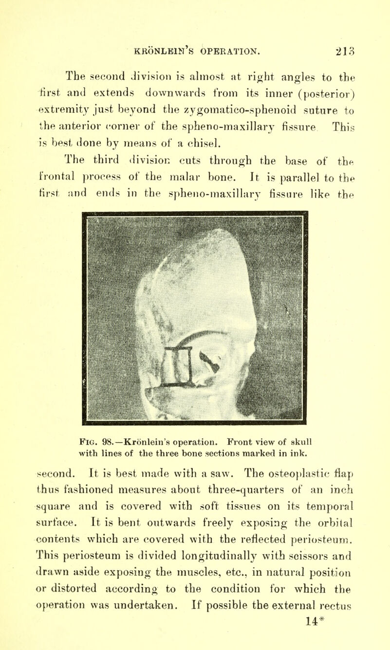 The second Jivision is almost at rioht angles to the lirst and extends downwards from its inner (posterior) extremity just beyond the zygomatico-sphenoid suture to the anterior corner of the spheno-maxillary fissure This is best done by means of a chisel. The third division cuts through the base of the frontal process of the malar bone. It is parallel to the first and ends in the spheno-maxillary fissure like the Fig. 98.—Kronlein's operation. Front view of skull with lines of the three bone sections marked in ink. second. It is best made with a saw. The osteo})lastic flap thus fashioned measures about three-quarters of an inch square and is covered with soft tissues on its temporal surface. It is bent outwards freely exposing the orbital contents which are covered with the reflected periosteum. This periosteum is divided longitudinally with scissors and drawn aside exposing the muscles, etc., in natural position or distorted according to the condition for which the operation was undertaken. If possible the external rectus 14*