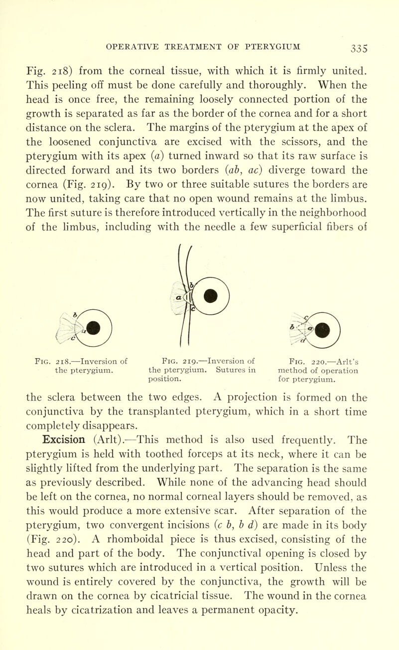 Fig. 218) from the corneal tissue, with which it is firmly united. This peeling off must be done carefully and thoroughly. When the head is once free, the remaining loosely connected portion of the growth is separated as far as the border of the cornea and for a short distance on the sclera. The margins of the pterygium at the apex of the loosened conjunctiva are excised with the scissors, and the pterygium with its apex (a) turned inward so that its raw surface is directed forward and its two borders (ab, ac) diverge toward the cornea (Fig. 219). By two or three suitable sutures the borders are now united, taking care that no open wound remains at the limbus. The first suture is therefore introduced vertically in the neighborhood of the hmbus, including with the needle a few superficial fibers of the sclera between the two edges. A projection is formed on the conjunctiva by the transplanted pterygium, which in a short time completely disappears. Excision (Arlt).—This method is also used frequently. The pterygium is held with toothed forceps at its neck, where it can be slightly lifted from the underlying part. The separation is the same as previously described. While none of the advancing head should be left on the cornea, no normal corneal layers should be removed, as this would produce a more extensive scar. After separation of the pterygium, two convergent incisions {c b, b d) are made in its body (Fig. 220). A rhomboidal piece is thus excised, consisting of the head and part of the body. The conjunctival opening is closed by two sutures which are introduced in a vertical position. Unless the wound is entirely covered by the conjunctiva, the growth will be drawn on the cornea by cicatricial tissue. The wound in the cornea heals by cicatrization and leaves a permanent opacity. Fig. 218.—Inversion of the pterygium. Fig. 219.—Inversion of the pterygium. Sutures in position. Fig. 220.—Arlt's method of operation for pterygium.