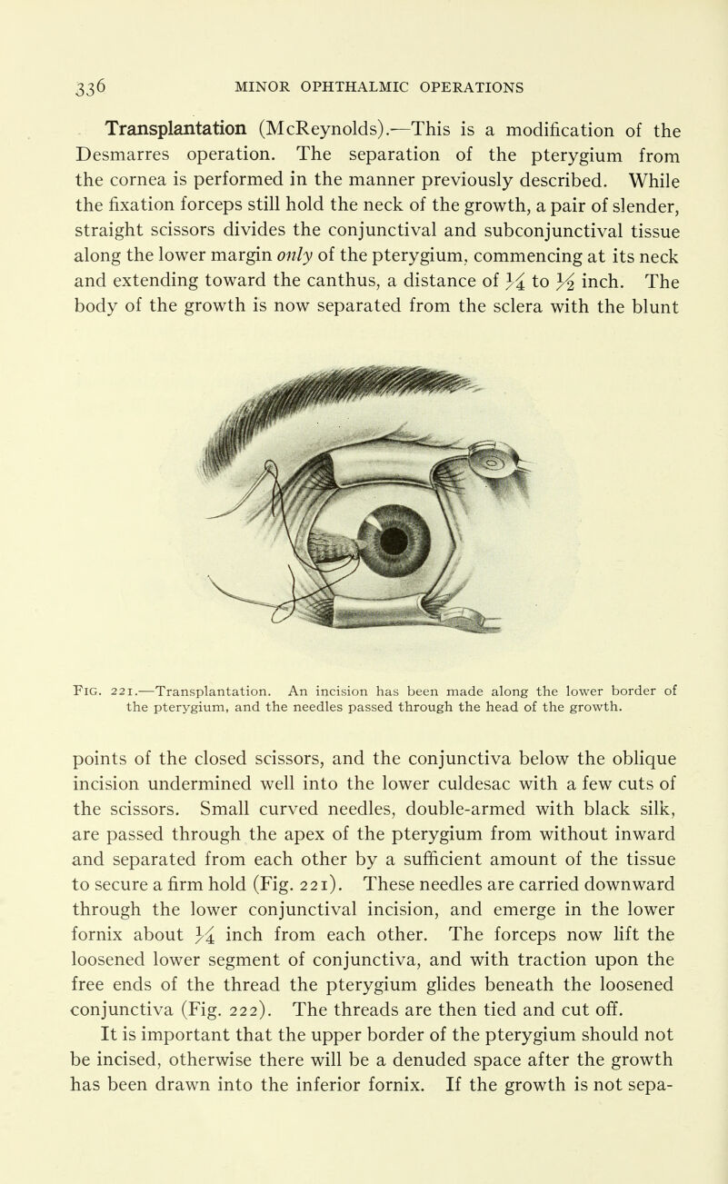 Transplantation (McReynolds).—This is a modification of the Desmarres operation. The separation of the pterygium from the cornea is performed in the manner previously described. While the fixation forceps still hold the neck of the growth, a pair of slender, straight scissors divides the conjunctival and subconjunctival tissue along the lower margin only of the pterygium, commencing at its neck and extending toward the canthus, a distance of to inch. The body of the growth is now separated from the sclera with the blunt Fig. 221.—Transplantation. An incision has been made along the lower border of the pterygium, and the needles passed through the head of the growth. points of the closed scissors, and the conjunctiva below the oblique incision undermined well into the lower culdesac with a few cuts of the scissors. Small curved needles, double-armed with black silk, are passed through the apex of the pterygium from without inward and separated from each other by a sufficient amount of the tissue to secure a firm hold (Fig. 221). These needles are carried downward through the lower conjunctival incision, and emerge in the lower fornix about J-^ inch from each other. The forceps now lift the loosened lower segment of conjunctiva, and with traction upon the free ends of the thread the pterygium glides beneath the loosened conjunctiva (Fig. 222). The threads are then tied and cut off. It is important that the upper border of the pterygium should not be incised, otherwise there will be a denuded space after the growth has been drawn into the inferior fornix. If the growth is not sepa-