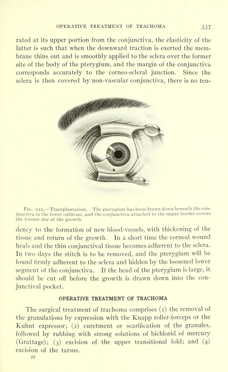 rated at its upper portion from the conjunctiva, the elasticity of the latter is such that when the downward traction is exerted the mem- brane thins out and is smoothly applied to the sclera over the former site of the body of the pterygium, and the margin of the conjunctiva corresponds accurately to the corneo-scleral junction. Since the sclera is then covered by non-vascular conjunctiva, there is no ten- FiG. 222.—Transplantation. The pterygium has been drawn down beneath the con- junctiva in the lower culdesac, and the conjunctiva attached to the upper border covers the former site of the growth. dency to the formation of new blood-vessels, with thickening of the tissue and return of the growth. In a short time the corneal wound heals and the thin conjunctival tissue becomes adherent to the sclera. In two days the stitch is to be removed, and the pterygium will be found firmly adherent to the sclera and hidden by the loosened lower segment of the conjunctiva. If the head of the pterygium is large, it should be cut off before the growth is drawn down into the con- junctival pocket. OPERATIVE TREATMENT OF TRACHOMA The surgical treatment of trachoma comprises (i) the removal of the granulations by expression with the Knapp roller-forceps or the Kuhnt expressor; (2) curetment or scarification of the granules, followed by rubbing with strong solutions of bichlorid of mercury (Grattage); (3) excision of the upper transitional fold; and (4) excision of the tarsus. 22