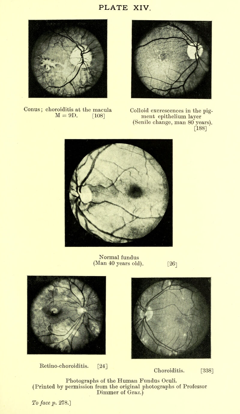 Conus ; choroiditis at the macula M = 9D. [108] Colloid excrescences in the pig- ment epithelium layer (Senile change, man 80 years). [188] Normal fundus (Man 40 years old). [26] Betino-choroiditis. [24] Choroiditis. [338] Photographs of the Human Fundus Oculi. (Printed by permission from the original photographs of Professor Dimmer of Graz.)