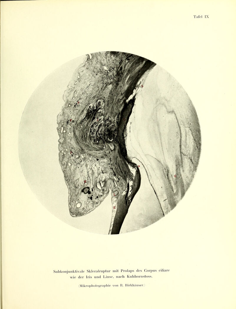 Subkoiijuiiklivale Sklcralruplur mil Prolaps des Coipus ciliare wie der Iris und Linse, nach Kulihornstoss. (Mikrophotographie von 1>. I3irkhi'iuser.)