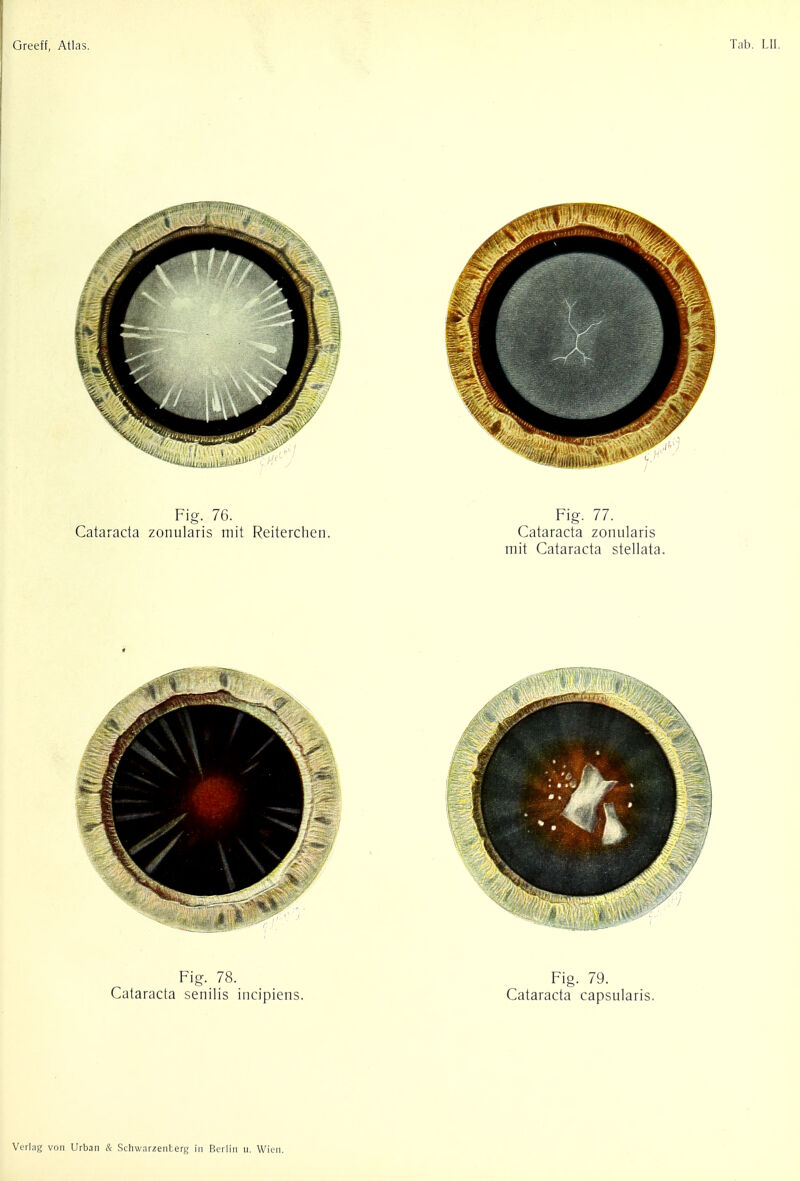 Fig. 76. Fig. 77. Cataracta zonularis mit Reiterchen. Cataracta zonularis mit Cataracta stellata.