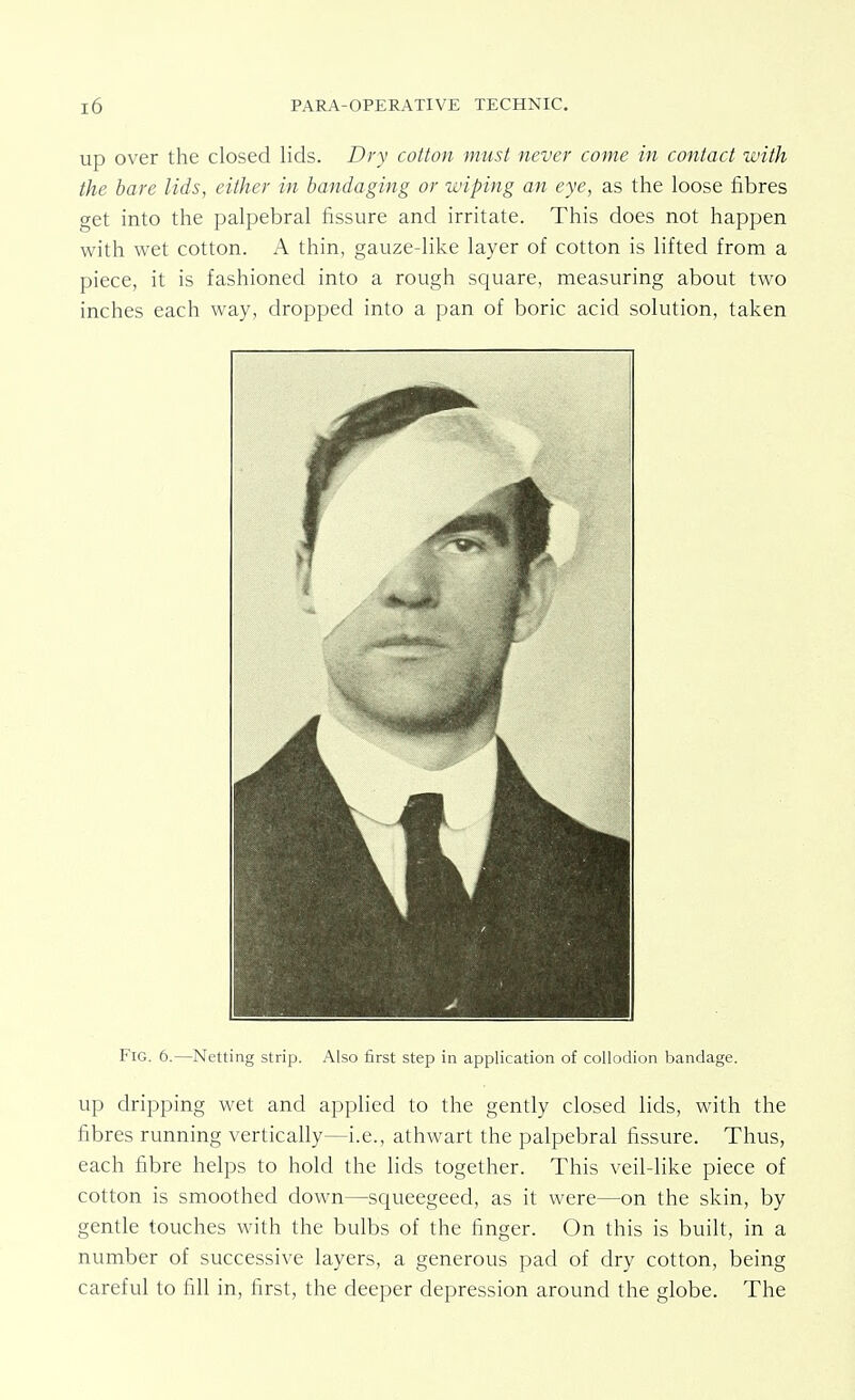 up over the closed lids. Dry cotton must never come in contact with the bare lids, either in bandaging or wiping an eye, as the loose fibres get into the palpebral fissure and irritate. This does not happen with wet cotton. A thin, gauze-like layer of cotton is lifted from a piece, it is fashioned into a rough square, measuring about two inches each way, dropped into a pan of boric acid solution, taken Fig. 6.—Netting strip. Also first step in application of collodion bandage. up dripping wet and applied to the gently closed lids, with the fibres running vertically—i.e., athwart the palpebral fissure. Thus, each fibre helps to hold the lids together. This veil-like piece of cotton is smoothed down—squeegeed, as it were—on the skin, by gentle touches with the bulbs of the finger. On this is built, in a number of successive layers, a generous pad of dry cotton, being careful to fill in, first, the deeper depression around the globe. The