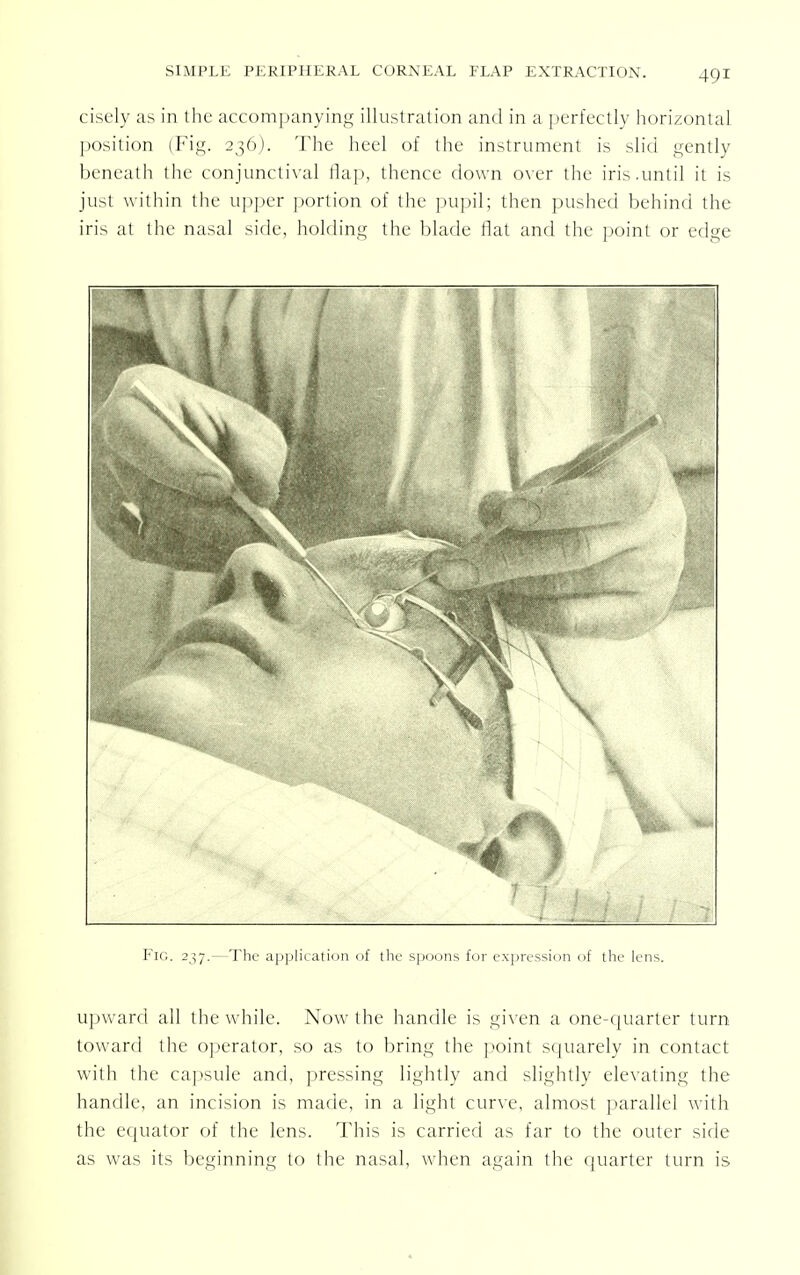 cisely as in the accompanying illustration and in a perfectly horizontal position (Fig. 236). The heel of the instrument is slid gently beneath the conjunctival flap, thence down over the iris.until it is just within the upper portion of the pupil; then pushed behind the iris at the nasal side, holding the blade flat and the point or edge Fig. 237.—The application of the spoons for expression of the lens. upward all the while. Now the handle is given a one-quarter turn toward the operator, so as to bring the point squarely in contact with the capsule and, pressing lightly and slightly elevating the handle, an incision is marie, in a light curve, almost parallel with the equator of the lens. This is carried as far to the outer side as wras its beginning to the nasal, when again the quarter turn is