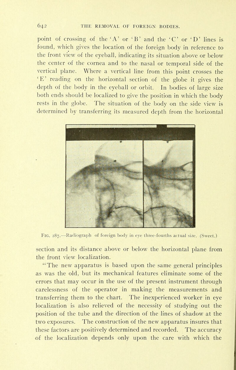 point of crossing of the 'A' or 'B' and the 'C or 'D' lines is found, which gives the location of the foreign body in reference to the front view of the eyeball, indicating its situation above or below the center of the cornea and to the nasal or temporal side of the vertical plane. Where a vertical line from this point crosses the 'E' reading on the horizontal section of the globe it gives the depth of the body in the eyeball or orbit. In bodies of large size both ends should be localized to give the position in which the body rests in the globe. The situation of the body on the side view is determined by transferring its measured depth from the horizontal Fig. 287.—Radiograph of foreign body in eye three-fourths actual size. (Sweet.) section and its distance above or below the horizontal plane from the front view localization. The new apparatus is based upon the same general principles as was the old, but its mechanical features eliminate some of the errors that may occur in the use of the present instrument through carelessness of the operator in making the measurements and transferring them to the chart. The inexperienced worker in eye localization is also relieved of the necessity of studying out the position of the tube and the direction of the lines of shadow at the two exposures. The construction of the new apparatus insures that these factors are positively determined and recorded. The accuracy of the localization depends only upon the care with which the