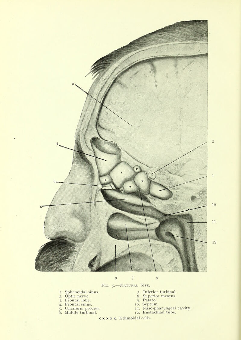 X X X X X. Ethmoidal cells.