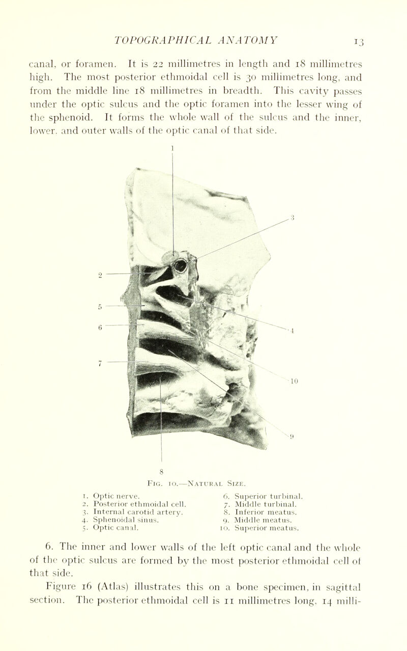 canal, or foramen. It is 22 millimetres in length and 18 millimetres high. The most posterior ethmoidal cell is 30 millimetres long, and from the middle line 18 millimetres in breadth. This cavity passes nnder the optic salens and the optic foramen into the lesser wing of the sphenoid. It forms the whole wall of the snlcns and the inner, lower, and onter walls of the optic canal of that side. 1 8 Fig. 10.—Natural Size. 1. Optic nerve. 6. Suju rioi tiirl.mal. 2. Posterior ethmoidal cell. 7. MhM h 1 m I ini.il. 3. Internal carotid artery. 8. InlniMi im im,. 4. Sphenoidal sinus. g. Midtllc mcit iis. 5. Optic canal. 10. Superior meatus. 6. The inner and lower walls of the left optic canal and the whole of the optic salens are formed by the most posterior ethmoidal <xdl ot that side. Figare i6 (Atlas) illastrates this on a bone specimen, in sagittal section. The posterior ethmoidal cell is ii millimetres long. 14 milli-