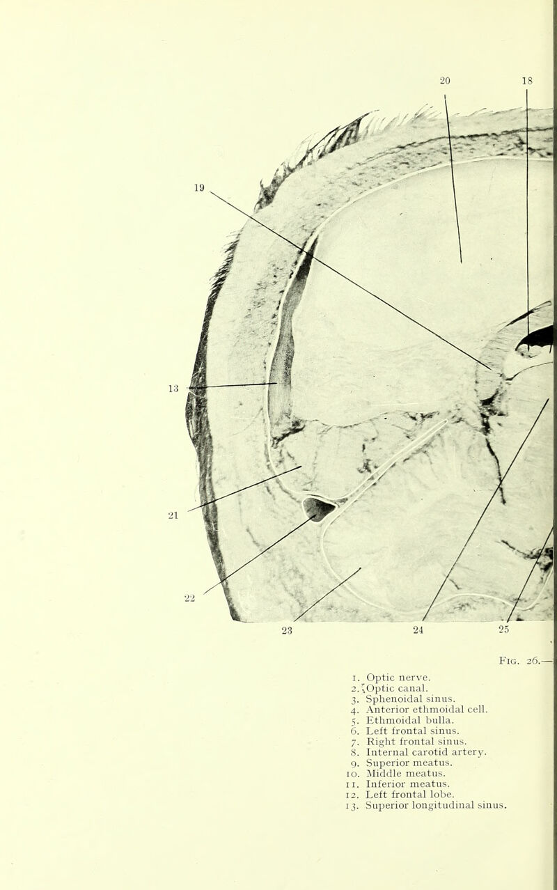 20 23 24 1. Optic nerve. 2. '.Optic canal. 3. Sphenoidal sinus. 4. Anterior etlimoidal cell. 5. Ethmoidal bulla. 6. Left frontal sinus. 7. Right frontal sinus. 8. Internal carotid artery. 9. Superior meatus. 10. Middle meatus. 11. Inferior meatus. 12. Left frontal lobe. 13. Superior longitudinal sinus.