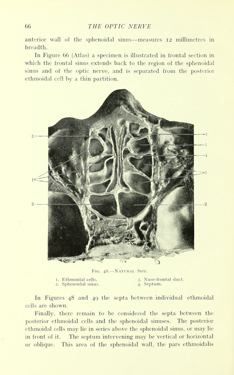 anterior wall of the sphenoidal sinus—measures 12 millimetres in breadth. In Figure 66 (Atlas) a specimen is illustrated in frontal section in which the frontal sinus extends back to the region of the sphenoidal sinus and of the optic nerve, and is separated from the posterior ethmoidal cell by a thin partition. l'iG. 4^,—Nati'kal Sizi;. 1. Ethmoidal cells. 3. Naso-frontal duct. 2. Sphenoidal sinus. 4. Septum. In Figures 48 and 49 the septa between individual ethmoidal cells are shown. Finally, there remain to be considered the septa between the posterior ethmoidal cells and the sphenoidal sinuses. The posterior ethmoidal cells may lie in series above the sphenoidal sinus, or may lie in front of it. The septum intervening may be vertical or horizontal or oblique. This area of the sphenoidal wall, the pars ethmoidalis