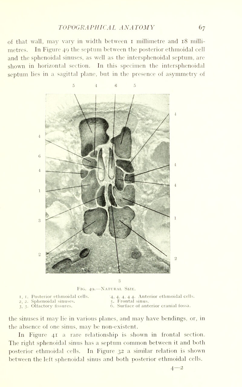 of that wall, may vary in width between i millimetre and 18 milli- metres. In Figure 4c) the septum between the posterior ethmoidal cell and the sphenoidal sinuses, as well as the intersphenoidal septum, are shown in horizontal section. In this specimen the intersphenoidal septum lies in a sagittal plane, but in the presence of asymmetry of 5 4 6 5 Fig. 49.—Natural Size. 1,1. Posterior ethmoidal cells. 4, 4, 4, 4 4. Anterior ethmoidal cells. 2, 2. Sphenoidal sinuses. 5. Frontal sinus. 3, 3. Olfactory fissures. 6. Surface of anterior cranial fossa. the sinuses it may lie in various planes, and may have bendings, or, in the absence of one sinus, may hi' non-existent. In Figure 41 a rare relationship is shown in frontal section. The right sphenoidal sinus has a septimi common between it and both posterior ethmoidal cells. In Figure 32 a similar relation is shown between the left sphenoidal sinus and both posterior ethmoidal cells.