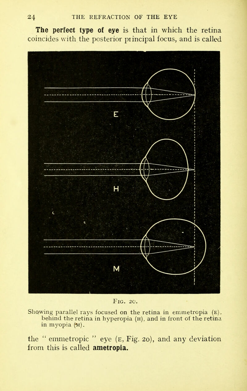 The perfect type of eye is that in which the retina coincides with the posterior principal focus, and is called Fig. 20. Shqwing parallel rays focused on the retina in emmetropia (e), behind the retina in hyperopia (h), and in front of the retina in myopia (ivi). the  emmetropic  eye (e, Fig. 20), and any deviation from this is called ametropia.