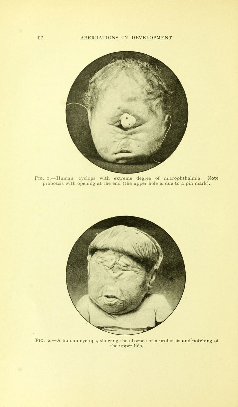 Fig. 2.—A human cyclops, showing the absence of a proboscis and notching of the upper lids.