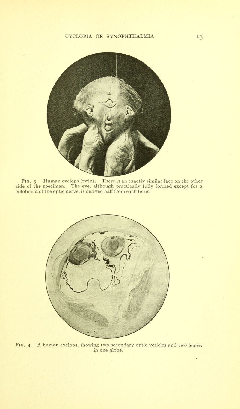 Fig. 4.—A human cyclops, showing two secondary optic vesicles and two lenses in one globe.