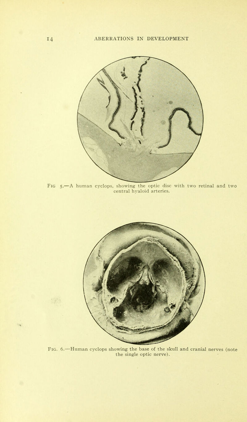 Fig. 6, .—Human cyclops showing the base of the skull and cranial nerves (note the single optic nerve).
