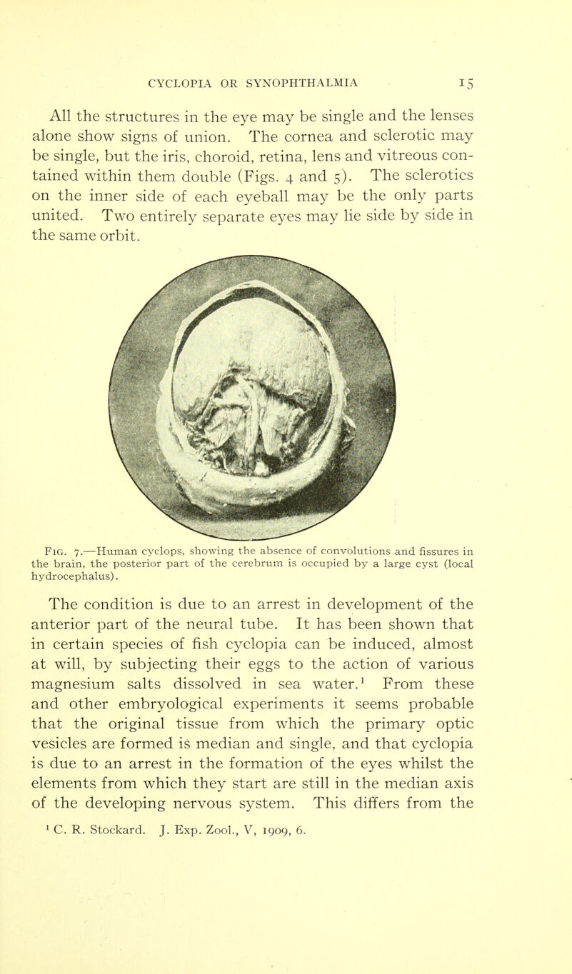 All the structures in the eye may be single and the lenses alone show signs of union. The cornea and sclerotic may be single, but the iris, choroid, retina, lens and vitreous con- tained within them double (Figs. 4 and 5). The sclerotics on the inner side of each eyeball may be the only parts united. Two entirely separate eyes may He side by side in the same orbit. Fig. 7.—Human cyclops, showing the absence of convolutions and fissures in the brain, the posterior part of the cerebrum is occupied by a large cyst (local hydrocephalus). The condition is due to an arrest in development of the anterior part of the neural tube. It has been shown that in certain species of fish cyclopia can be induced, almost at will, by subjecting their eggs to the action of various magnesium salts dissolved in sea water. ^ From these and other embryological experiments it seems probable that the original tissue from which the primary optic vesicles are formed is median and single, and that cyclopia is due to an arrest in the formation of the eyes whilst the elements from which they start are still in the median axis of the developing nervous system. This differs from the ^ C. R. Stockard. J. Exp. Zool., V, 1909, 6.