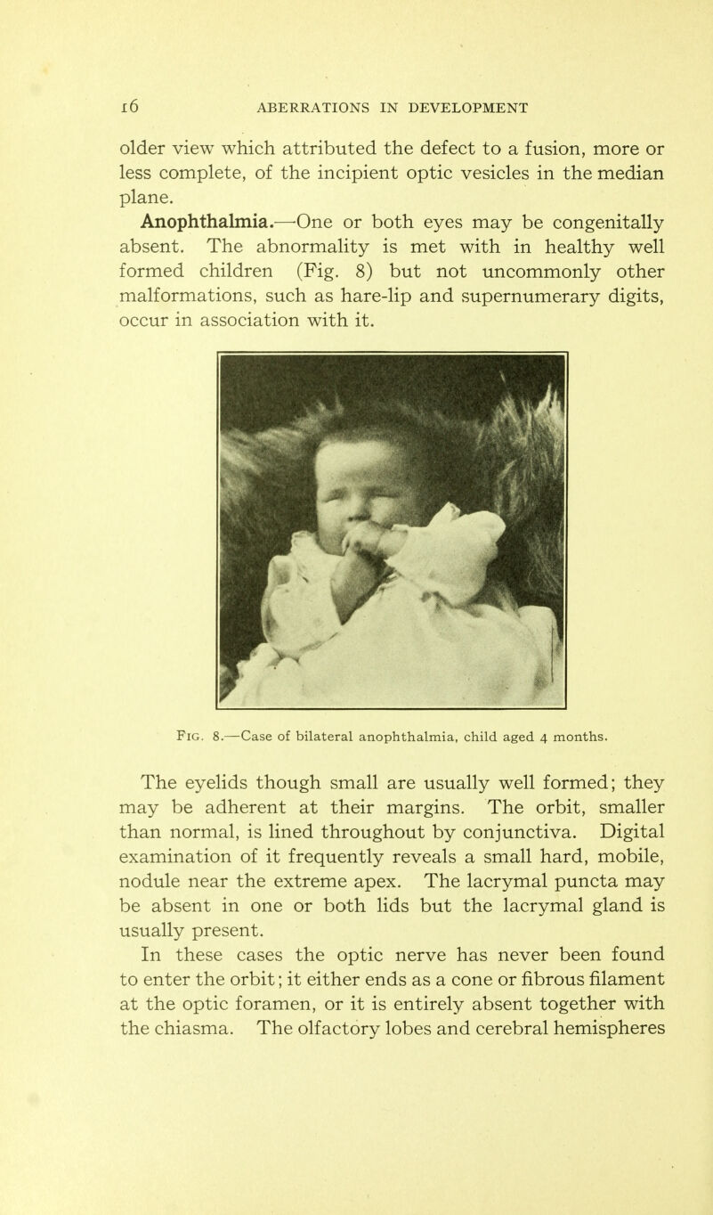 older view which attributed the defect to a fusion, more or less complete, of the incipient optic vesicles in the median plane. Anophthalmia.—-One or both eyes may be congenitally absent. The abnormality is met with in healthy well formed children (Fig. 8) but not uncommonly other malformations, such as hare-lip and supernumerary digits, occur in association with it. The eyelids though small are usually well formed; they may be adherent at their margins. The orbit, smaller than normal, is lined throughout by conjunctiva. Digital examination of it frequently reveals a small hard, mobile, nodule near the extreme apex. The lacrymal puncta may be absent in one or both lids but the lacrymal gland is usually present. In these cases the optic nerve has never been found to enter the orbit; it either ends as a cone or fibrous filament at the optic foramen, or it is entirely absent together with the chiasma. The olfactory lobes and cerebral hemispheres Fig. 8.—Case of bilateral anophthalmia, child aged 4 months.