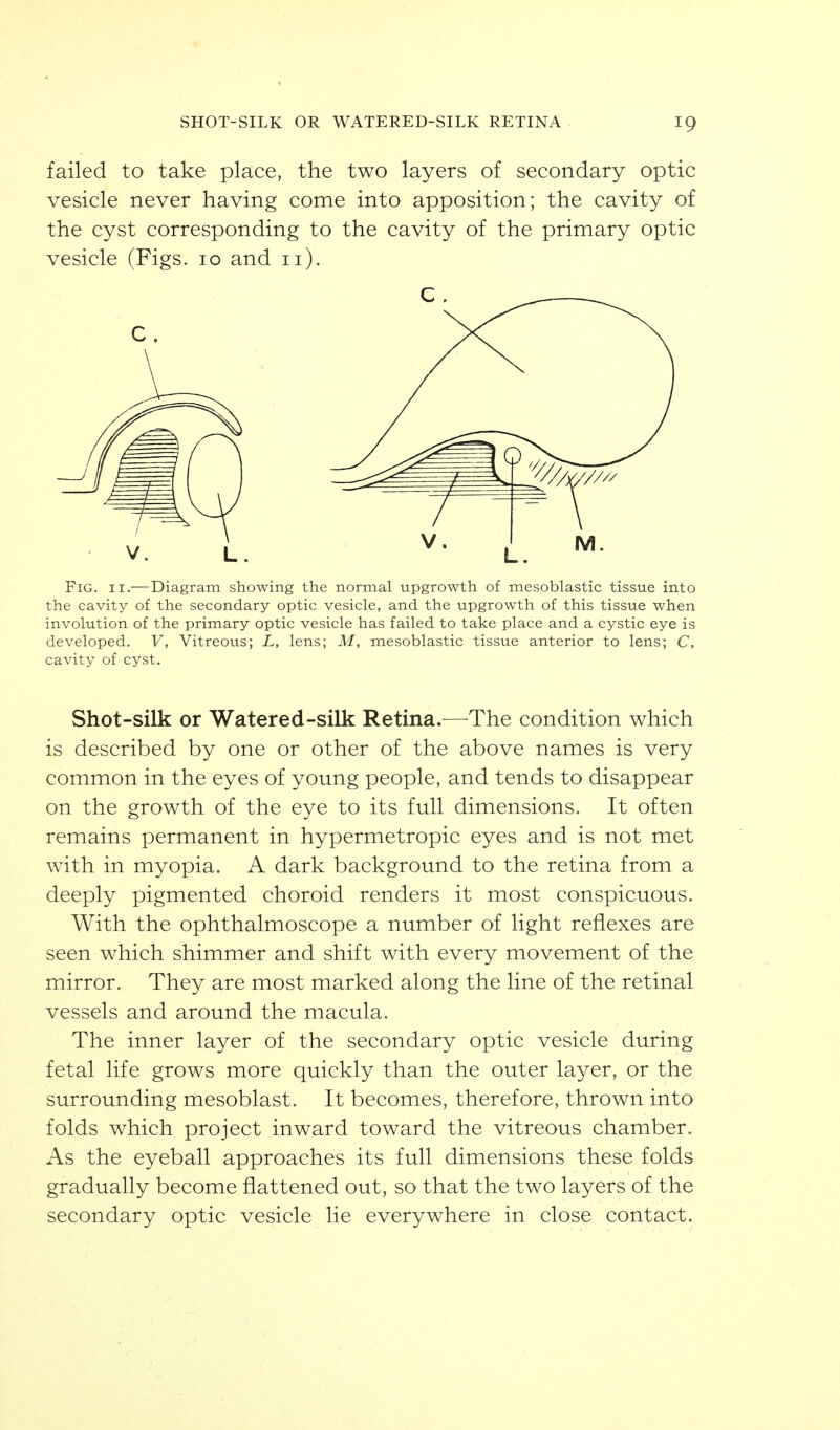 failed to take place, the two layers of secondary optic vesicle never having come into apposition; the cavity of the cyst corresponding to the cavity of the primary optic vesicle (Figs. 10 and 11). C . Fig. II.—Diagram showing the normal upgrowth of mesoblastic tissue into the cavity of the secondary optic vesicle, and the upgrowth of this tissue when involution of the primary optic vesicle has failed to take place and a cystic eye is developed. V, Vitreous; L, lens; M, mesoblastic tissue anterior to lens; C, cavity of cyst. Shot-silk or Watered-silk Retina.—^The condition which is described by one or other of the above names is very common in the eyes of young people, and tends to disappear on the growth of the eye to its full dimensions. It often remains permanent in hypermetropic eyes and is not met with in myopia. A dark background to the retina from a deeply pigmented choroid renders it most conspicuous. With the ophthalmoscope a number of light reflexes are seen which shimmer and shift with every movement of the mirror. They are most marked along the line of the retinal vessels and around the macula. The inner layer of the secondary optic vesicle during fetal life grows more quickly than the outer layer, or the surrounding mesoblast. It becomes, therefore, thrown into folds which project inward toward the vitreous chamber. As the eyeball approaches its full dimensions these folds gradually become flattened out, so that the two layers of the secondary optic vesicle lie everywhere in close contact.