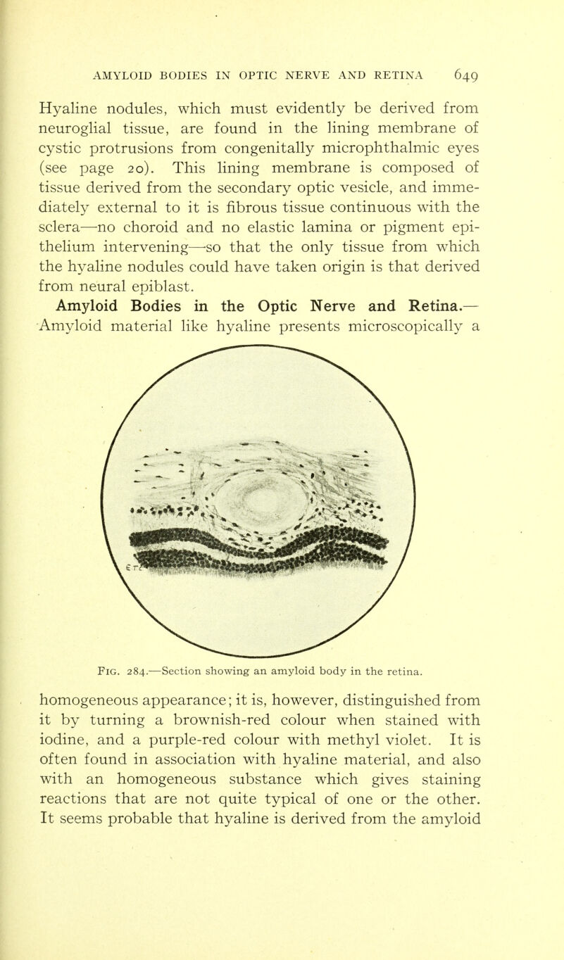 Hyaline nodules, which must evidently be derived from neuroglial tissue, are found in the lining membrane of cystic protrusions from congenitally microphthalmic eyes (see page 20). This lining membrane is composed of tissue derived from the secondary optic vesicle, and imme- diately external to it is fibrous tissue continuous with the sclera—no choroid and no elastic lamina or pigment epi- thelium intervening—-so that the only tissue from which the hyaline nodules could have taken origin is that derived from neural epiblast. Amyloid Bodies in the Optic Nerve and Retina.— Amyloid material like hyaline presents microscopically a Fig. 284.—Section showing an amyloid body in the retina. homogeneous appearance; it is, however, distinguished from it by turning a brownish-red colour when stained with iodine, and a purple-red colour with methyl violet. It is often found in association with hyaline material, and also with an homogeneous substance which gives staining reactions that are not quite typical of one or the other. It seems probable that hyaline is derived from the amyloid