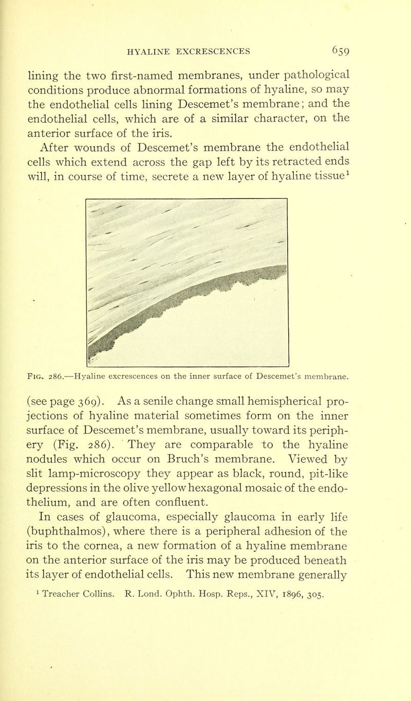 HYALINE EXCRESCENCES lining the two first-named membranes, under pathological conditions produce abnormal formations of hyaline, so may the endothelial cells lining Descemet's membrane; and the endothelial cells, which are of a similar character, on the anterior surface of the iris. After wounds of Descemet's membrane the endothelial cells which extend across the gap left by its retracted ends will, in course of time, secrete a new layer of hyaline tissue^ Fig, 286.—Hyaline excrescences on the inner surface of Descemet's membrane. (see page 369). As a senile change small hemispherical pro- jections of hyaline material sometimes form on the inner surface of Descemet's membrane, usually toward its periph- ery (Fig. 286). They are comparable to the hyaline nodules which occur on Bruch's membrane. Viewed by slit lamp-microscopy they appear as black, round, pit-like depressions in the olive yellow hexagonal mosaic of the endo- thelium, and are often confluent. In cases of glaucoma, especially glaucoma in early life (buphthalmos), where there is a peripheral adhesion of the iris to the cornea, a new formation of a hyaline membrane on the anterior surface of the iris may be produced beneath its layer of endothelial cells. This new membrane generally ^ Treacher CoUins. R. Lond. Ophth. Hosp. Reps., XIV, 1896, 305.