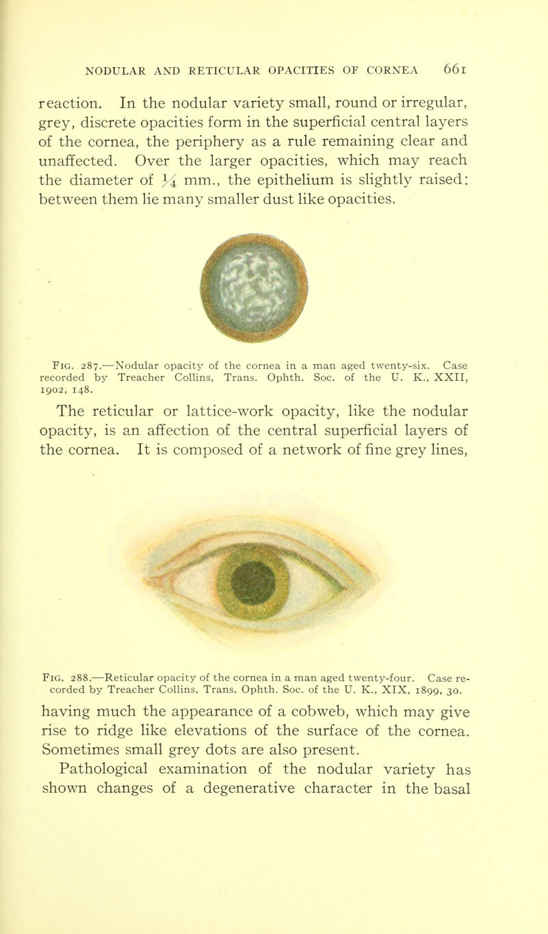 reaction. In the nodular variety small, round or irregular, grey, discrete opacities form in the superficial central layers of the cornea, the periphery as a rule remaining clear and unaffected. Over the larger opacities, which may reach the diameter of mm., the epithelium is slightly raised: between them lie many smaller dust like opacities. Fig. 287.—Nodular opacity of the cornea in a man aged twenty-six. Case recorded by Treacher Colhns, Trans. Ophth. Soc. of the U. K., XXII, 1902, 148. The reticular or lattice-work opacity, like the nodular opacity, is an affection of the central superficial layers of the cornea. It is composed of a network of fine grey lines, Fig. 288.—Reticular opacity of the cornea in a man aged twenty-four. Case re- corded by Treacher Collins, Trans. Ophth. Soc. of the U. K., XIX, 1899, 30. having much the appearance of a cobweb, which may give rise to ridge like elevations of the surface of the cornea. Sometimes small grey dots are also present. Pathological examination of the nodular variety has shown changes of a degenerative character in the basal