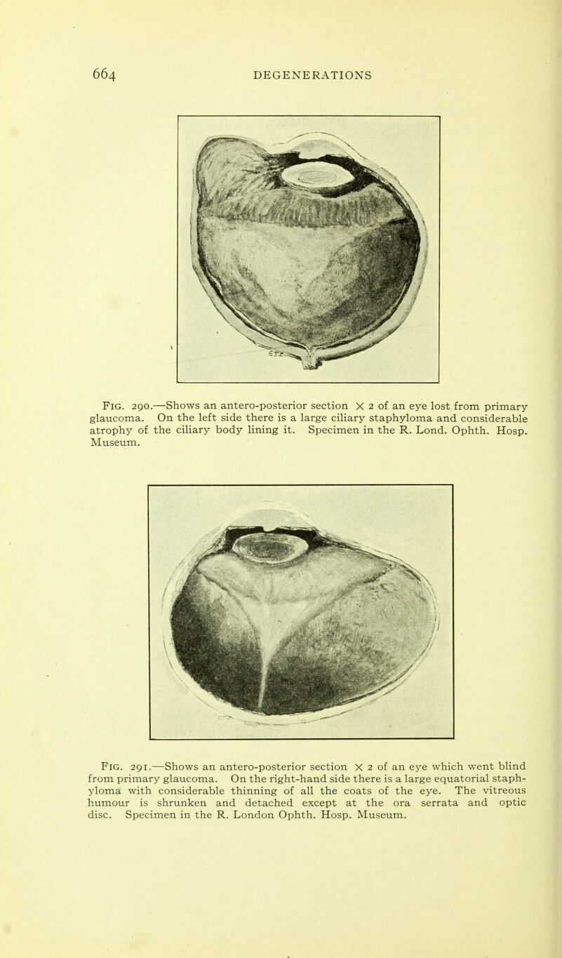 Fig. 290.—Shows an antero-posterior section X 2 of an eye lost from primary glaucoma. On the left side there is a large ciliary staphyloma and considerable atrophy of the ciliary body lining it. Specimen in the R. Lond. Ophth. Hosp. Museum. Fig. 291.—Shows an antero-posterior section X 2 of an eye which went blind from primary glaucoma. On the right-hand side there is a large equatorial staph- yloma with considerable thinning of all the coats of the eye. The vitreous humour is shrunken and detached except at the ora serrata and optic disc. Specimen in the R. London Ophth. Hosp. Museum.