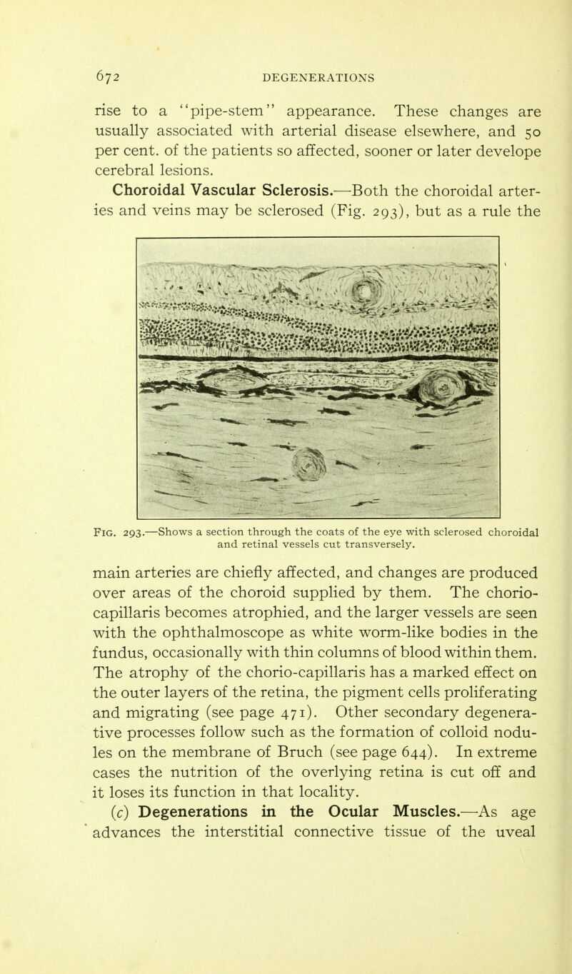 rise to a pipe-stem appearance. These changes are usually associated with arterial disease elsewhere, and 50 per cent, of the patients so affected, sooner or later develope cerebral lesions. Choroidal Vascular Sclerosis.—Both the choroidal arter- ies and veins may be sclerosed (Fig. 293), but as a rule the Fig, 293.—Shows a section through the coats of the eye with sclerosed choroidal and retinal vessels cut transversely. main arteries are chiefly affected, and changes are produced over areas of the choroid supplied by them. The chorio- capillaris becomes atrophied, and the larger vessels are seen with the ophthalmoscope as white worm-like bodies in the fundus, occasionally with thin columns of blood within them. The atrophy of the chorio-capillaris has a marked effect on the outer layers of the retina, the pigment cells proliferating and migrating (see page 471). Other secondary degenera- tive processes follow such as the formation of colloid nodu- les on the membrane of Bruch (see page 644). In extreme cases the nutrition of the overlying retina is cut off and it loses its function in that locality. (c) Degenerations in the Ocular Muscles.—As age advances the interstitial connective tissue of the uveal