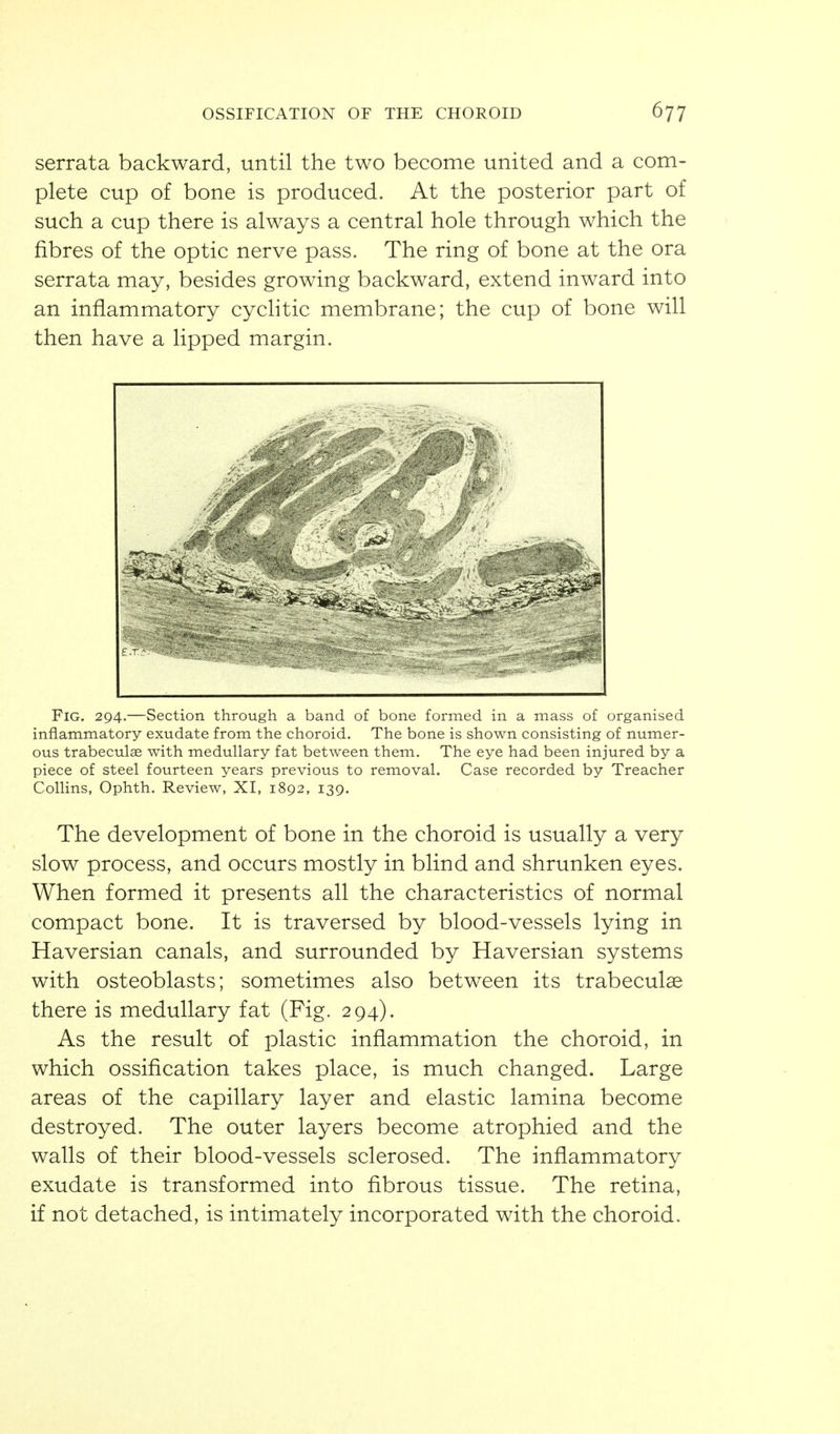 serrata backward, until the two become united and a com- plete cup of bone is produced. At the posterior part of such a cup there is always a central hole through which the fibres of the optic nerve pass. The ring of bone at the ora serrata may, besides growing backward, extend inward into an inflammatory cychtic membrane; the cup of bone will then have a lipped margin. Fig. 294.—Section through a band of bone formed in a mass of organised inflammatory exudate from the choroid. The bone is shown consisting of numer- ous trabeculae with medullary fat between them. The eye had been injured by a piece of steel fourteen years previous to removal. Case recorded by Treacher Collins, Ophth. Review, XI, 1892, 139. The development of bone in the choroid is usually a very slow process, and occurs mostly in blind and shrunken eyes. When formed it presents all the characteristics of normal compact bone. It is traversed by blood-vessels lying in Haversian canals, and surrounded by Haversian systems with osteoblasts; sometimes also between its trabeculae there is medullary fat (Fig. 294). As the result of plastic inflammation the choroid, in which ossification takes place, is much changed. Large areas of the capillary layer and elastic lamina become destroyed. The outer layers become atrophied and the walls of their blood-vessels sclerosed. The inflammatory exudate is transformed into fibrous tissue. The retina, if not detached, is intimately incorporated with the choroid.