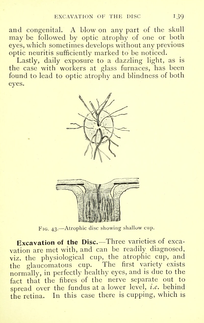 and congenital. A blow on any part of the skull may be followed by optic atrophy of one or both eyes, which sometimes develops without any previous optic neuritis sufficiently marked to be noticed. Lastly, daily exposure to a dazzling light, as is the case with workers at glass furnaces, has been found to lead to optic atrophy and blindness of both eyes. Fig. 43.—Atrophic disc showing shallow cup. Excavation of the Disc—Three varieties of exca- vation are met with, and can be readily diagnosed, viz. the physiological cup, the atrophic cup, and the glaucomatous cup. The first variety exists normally, in perfectly healthy eyes, and is due to the fact that the fibres of the nerve separate out _ to spread over the fundus at a lower level, i.e. behind the retina. In this case there is cupping, which is