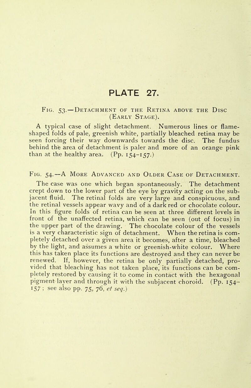 Fig. 53.—Detachment of the Retina above the Disc (Early Stage). A typical case of slight detachment. Numerous lines or flame- shaped folds of pale, greenish white, partially bleached retina may be seen forcing their way downwards towards the disc. The fundus behind the area of detachment is paler and more of an orange pink than at the healthy area. (Pp. 154-157.) Fig. 54.—A More Advanced and Older Case of Detachment. The case was one which began spontaneously. The detachment crept down to the lower part of the eye by gravity acting on the sub- jacent fluid. The retinal folds are very large and conspicuous, and the retinal vessels appear wavy and of a dark red or chocolate colour. In this figure folds of retina can be seen at three different levels in front of the unaffected retina, which can be seen (out of focus) in the upper part of the drawing. The chocolate colour of the vessels is a very characteristic sign of detachment. When the retina is com- pletely detached over a given area it becomes, after a time, bleached by the light, and assumes a white or greenish-white colour. Where this has taken place its functions are destroyed and they can never be renewed. If, however, the retina be only partially detached, pro- vided that bleaching has not taken place, its functions can be com- pletely restored by causing it to come in contact with the hexagonal pigment layer and through it with the subjacent choroid. (Pp. 154- 157 ; see also pp. 75, 76, et seq.)