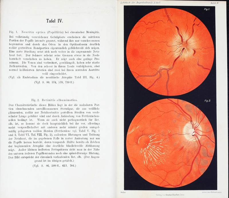Li-hi-hiii}i der Auyenheilbinidc.J.Aiit'L Tafel IV. Fig. 1. Neuritis optica (Papillitis) bei chronischer Meningitis. Bei vollständig verstrichener Gefäßpforte erscheinen die mittleren Partien der Papille intensiv graurot, während ihre nur verschwommen begrenzten und durch das Ödem in den Optikusfasern deutlich radiär gestreiften Eandpartien eigentümlich gelbhchweiß sich zeigen. Eine zarte Streifung setzt sich noch weiter in die angrenzende Netz- haut fort. Der Sehnerv scheint seine Grenzen etwas in die Nach- barschaft verschoben zu haben. Er zeigt auch eine geringe Pro- minenz. Die Venen sind verbreitert, geschlängelt, haben sehr starke Eeflexstreifen. Von den schwer in ihrem I^aufe verfolgbaren, aber normal kalibrierten Arterien sind zwei bei ihrem zentralen Austritte weiß eingescheidet. (Vgl. als Endstadium die neuritisohe Atrophie Tafel III, Fig. 4.) (Vgl. S. 80, 574, 578, 710 ff.) Fig. 2. Eetinitis albuminurica. Das Charakteristische dieses Bildes liegt in der die makularen Par- tien einnehmenden unvollkommenen Sternligur, die aus weißhch- glänzenden, radiär zur Netzhautmitte gestellten Streifen von wech- selnder Länge gebildet wird und durch Anhäufung von Fettkörnchen- zellen bedingt ist. Wenn sie auch iiieht pathognostisch für Ret. alb. ist, so kommt sie doch hauptsächlich bei ihr vor, allerdings meist vergesellschaftet mit anderen mehr minder großen unregel- mäßig gelagerten weißen Herden (Fettherden: vgl. Tafel V, Fig. 1 und 2, Tafel VI, Taf. VII, Fig. 2), außerdem Blutungen und Trübung der Netzhaut, die im gegebenen Falle in zarter Andeutung nur um die Papille herum besteht, deren temporale HäU'te bereits als Zeichen der beginnenden Atrophie eine deuthche bläulichweiße Abblassung zeigt. Außer kleinen isoh'erten Fettspritzern sieht man in der Nähe des unteren äußeren PapiUenrandes noch eine spindelförmige Blutung. Das Bild entspricht der chronisch verlaufenden Ret. alb. (Der Augen- grund ist im übrigen getäfelt.) (Vgl. S. 86, 599 ff., 613. 704.)