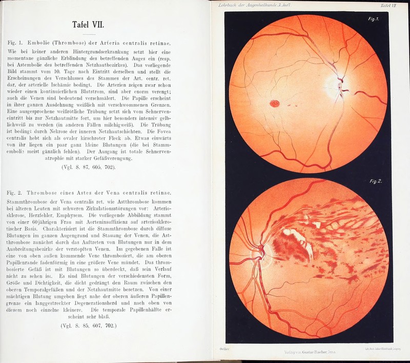 Fig. 1. Embolie (Thrombose) der Arferia centralis retinae. Wie bei keiner anderen Hintergrund serkranlsnng setzt hier eine momentane gänzliche Erblindung des betreffenden Auges ein (resp. bei AstemboUe des betreffenden Netzhautbezirkes). Das vorhegende Bild stammt vom 10. Tage nach Eintritt derselben und stellt die Erscheinungen des Verschlusses des Stammes der Art. centr. ret. dar, der arterielle Ischämie bedingt. Die Ai-terien zeigen zwar schon wieder einen kontinuierhehen Blutstrom, sind aber enorm verengt; auch die Venen sind bedeutend verschmälert. Die Papille erscheint in ihrer ganzen Ausdehnung weißhch mit verschwommenen Grenzen. Eine ausgesprochene weißröthche Trübung setzt sich vom Sehnerven- eintritt bis zur Netzhautmitte fort, um hier besonders intensiv gelb- lichweiß zu werden (in anderen Fällen milchig weiß). Die Trübung ist bedingt durch Nekrose der inneren Netzhautschichten. Die Fovea centralis hebt sich als ovaler kirschroter Fleck ab. Etwas einwärts von ihr liegen ein paar ganz kleine Blutungen (die bei Stamm- embolis meist gänzlich fehlen). Der Ausgang ist totale Sehnerven- atrophie mit starker Gefäßverengung. (Vgl. S. 87, 605, 702). Fig. 2. Thrombose eines Astes der Vena centralis retinae. Stammthrombose der Vena centralis ret. wie Astthrombose kommen bei älteren Leuten mit schweren Zirkulationsstörungen vor: Arterio- sklerose, Herzfehler, Emphysem. Die vorliegende Abbildung stammt von einer 60jährigen Frau mit Aorteninsuffizienz auf arteriosklero- tischer Basis. Charakterisiert ist die Stammthrombose durch diffuse Blutungen im ganzen Augengrund und Stauung der Venen, die Ast- thrombose zunächst durch das Auftreten von Blutungen nur in dem Ausbreitungsbezirke, der verstopften Venen. Im gegebenen Falle ist eine von oben außen kommende Vene throrabosiert, die am oberen PapiUenrande fadenförmig in eine größere Vene mündet. Das throm- bosierte Gefäß ist mit Blutungen so überdeckt, daß sein Verlauf nicht zu sehen isc. Es sind Blutungen der verschiedensten Form, Größe und Dichtigkeit, die dicht gedrängt den Raum zwischen den oberen Temporalgefäßen und der Netzhautmitte besetzen. Von einer mächtigen Blutung umgeben hegt nahe der oberen äußeren Papillen- grenze ein langgestreckter Degenerationsherd und nach oben von diesem noch einzelne kleinere. Die temporale Papillenhälfte er- scheint sehr blaß.