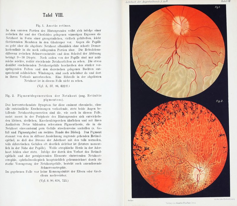 Fig. 1. Amotio retinae. In den unteren Partien des Hintergrundes wölbt sich infolge einer zwischen ihr und der Chorioidea gelegenen wässerigen Ergusses die Netzhaut in Form einer graugrünhohen, vielfach gefältelten, leicht flottierenden Membran in den Glaskörper vor. Gegen die Papille zu geht aber die abgelöste Netzhaut allraähhch ohne scharfe Demar- kationslinie in die noch anhegenden Partien über. Die Rofraktions- differenz zwischen Sehnerveneintritt und dem Scheitel der Ablösung beträgt 9—10 Dioptr. Nach außen von der Papille sind nur zahl- reiche seichte, radiär streichende Netzhautfalten zu sehen. Die etwas dunkler erscheinenden Netzhautgefäße beschreiben den stärker vor- springenden Falten und den dazwischen gelegenen Buchten ent- sprechend zahlreichere Windungen, sind auch scheinbar da und dort in ihrem Verlaufe unterbrochen. Eine Eißstelle in der abgelösten Netzhaut ist in diesem Falle nicht zu sehen. (Vgl. S. 57, 86, 622 ff.1 Fig. 2. Pigmentdegeneration der Netzhaut (sog. Retinitis pigmentosa). Das hervorstechendste Symptom für diese eminent chronische, ohne alle entzündhehe Erscheinungen verlaufende, stets beide Augen be- fallende Netzhautdegeneration sind die, wie auch in diesem Falle, meist zuerst in der Peripherie des Hintergrundes sich entwickeln- den kleinen, zierhchen, Knochenkörperchen ähnlichen und mit ihren Ausläufern Netze bildenden schwarzen Pigmentherde, die in die Netzhaut einwandernd gern Gefäße streckenweise umhüllen (s. Ge- fäß und Pigmentgabel am rechten Rande des Bildes). Das Pigment stammt von dem in diffuser Ausdehnung zugrunde gehenden Retinal- epithel, so daß das Stroma der Aderhaut mit den teils normalen, teils sklerotischen Gefäßen oft deuthch sichtbar ist (letztere nament- lich in der Nähe der Papille). Weiße atrophische Herde in der Ader- haut fehlen aber stets. Infolge der durch den Verlust des Retinal- epithels und der perzipierenden Elemente eintretenden Netzhaut- atrophie, ophthalmoskopisch hauptsächüch gekennzeichnet durch die starke Verengerung der Netzhautgefäße, besteht auch aszendierende Sehnervenatrophie. Im gegebenen Falle war keine Konsanguinität der Eltern oder Groß- eltern nachweisbar.