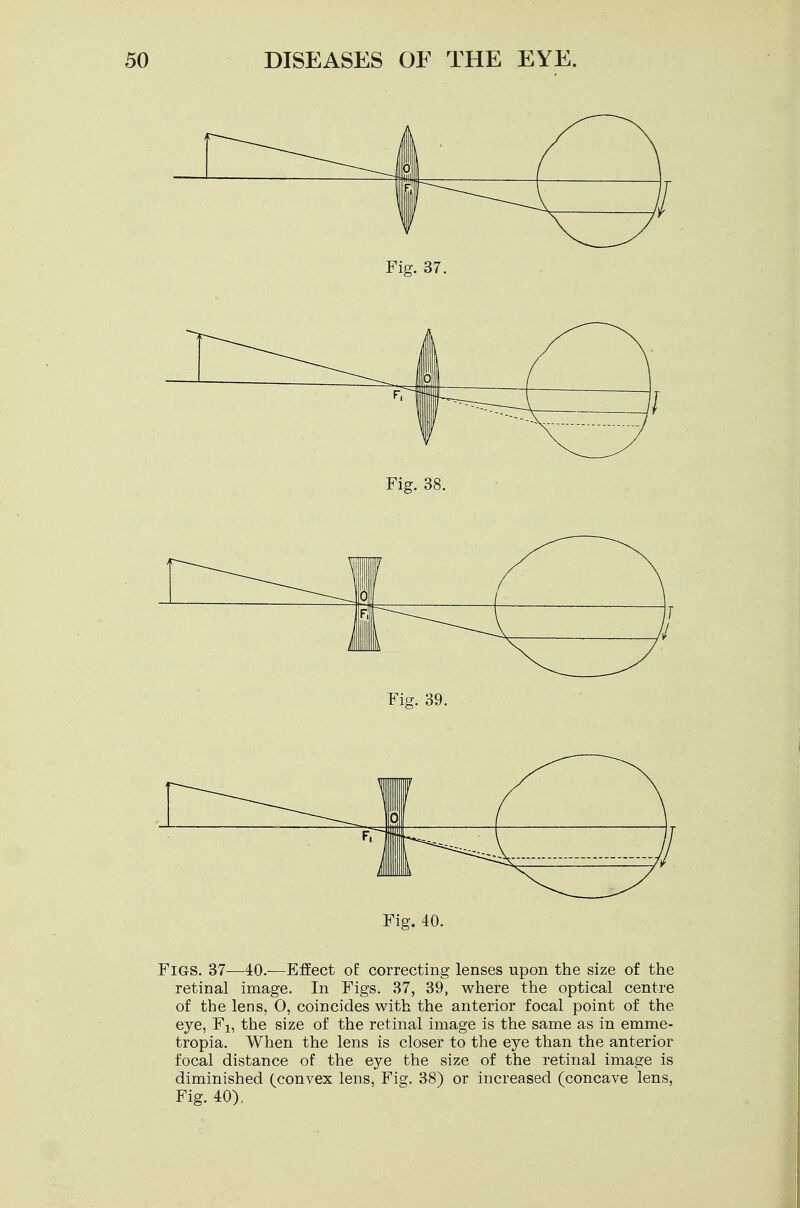 Fig. 37. Fig. 39. Fig. 40. Figs. 37-—40.—Effect ol correcting lenses upon the size of the retinal image. In Figs. 37, 39, where the optical centre of the lens, O, coincides with the anterior focal point of the eye, F1? the size of the retinal image is the same as in emme- tropia. When the lens is closer to the eye than the anterior focal distance of the eye the size of the retinal image is diminished (convex lens, Fig. 38) or increased (concave lens, Fig. 40),