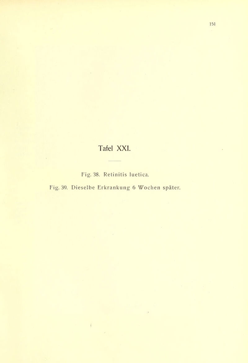 Tafel XXI. Fig. 38. Retinitis luetica. Fig. 39. Dieselbe Erkrankung 6 Wochen später.