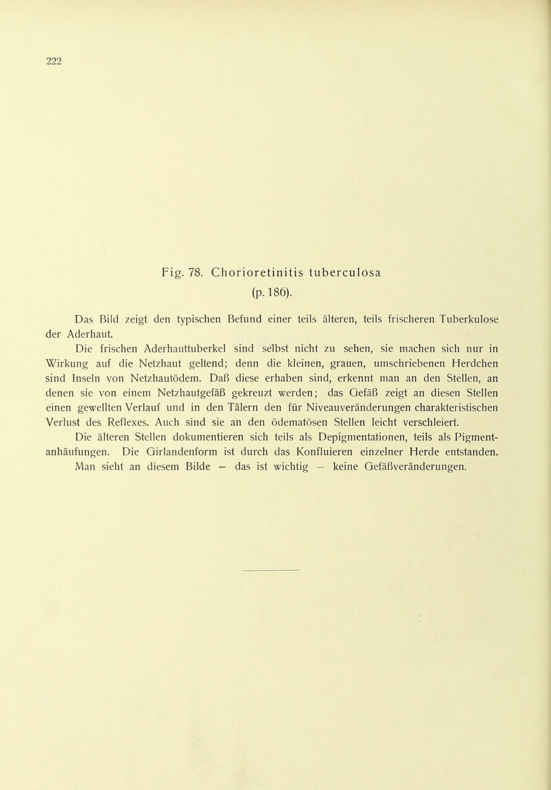 Fig. 78. Chorioretinitis tuberculosa (p.186). Das Bild zeigt den typischen Befund einer teils älteren, teils frischeren Tuberkulose der Aderhaut. Die frischen Aderhauttuberkel sind selbst nicht zu sehen, sie machen sich nur in Wirkung auf die Netzhaut geltend; denn die kleinen, grauen, umschriebenen Herdchen sind Inseln von Netzhautödem. Daß diese erhaben sind, erkennt man an den Stellen, an denen sie von einem Netzhautgefäß gekreuzt werden; das Gefäß zeigt an diesen Stellen einen gewellten Verlauf und in den Tälern den für Niveauveränderungen charakteristischen Verlust des Reflexes. Auch sind sie an den ödematösen Stellen leicht verschleiert. Die älteren Stellen dokumentieren sich teils als Depigmentationen, teils als Pigment- anhäufungen. Die Girlandenform ist durch das Konfluieren einzelner Herde entstanden. Man sieht an diesem Bilde — das ist wichtig — keine Gefäßveränderungen.