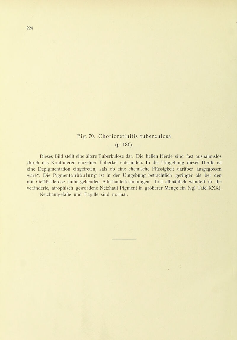 Fig. 79. Chorioretinitis tuberculosa (p. 186). Dieses Bild stellt eine ältere Tuberkulose dar. Die hellen Herde sind fast ausnahmslos durch das Konfluieren einzelner Tuberkel entstanden. In der Umgebung dieser Herde ist eine Depigmentation eingetreten, „als ob eine chemische Flüssigkeit darüber ausgegossen wäre. Die Pigmentanhäufung ist in der Umgebung beträchtlich geringer als bei den mit Gefäßsklerose einhergehenden Aderhauterkrankungen. Erst allmählich wandert in die veränderte, atrophisch gewordene Netzhaut Pigment in größerer Menge ein (vgl. Tafel XXX). Netzhautgefäße und Papille sind normal.