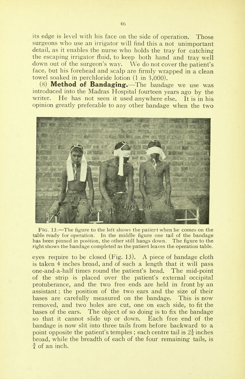 its edge is level with his face on the side of operation. Those surgeons who use an irrigator will find this a not unimportant detail, as it enables the nurse who holds the tray for catching the escaping irrigator fluid, to keep both hand and tray well down out of the surgeon's way. We do not cover the patient's face, but his forehead and scalp are firmly wrapped in a clean towel soaked in perchloride lotion (1 in 3,000). (8) Method of Bandaging.—The bandage we use was introduced into the Madras Hospital fourteen years ago by the writer. He has not seen it used anywhere else. It is in his opinion greatly preferable to any other bandage when the two Fig. 13.—The figure to the left shows the patient when he comes on the table ready for operation. In the middle figure one tail of the bandage has been pinned in position, the other still hangs down. The figure to the right shows the bandage completed as the patient leaves the operation table. eyes require to be closed (Fig. 13). A piece of bandage cloth is taken 4 inches broad, and of such a length that it will pass one-and-a-half times round the patient's head. The mid-point of the strip is placed over the patient's external occipital protuberance, and the two free ends are held in front by an assistant; the position of the two ears and the size of their bases are carefully measured on the bandage. This is now removed, and two holes are cut, one on each side, to fit the bases of the ears. The object of so doing is to fix the bandage so that it cannot slide up or down. Each free end of the bandage is now slit into three tails from before backward to a point opposite the patient's temples ; each centre tail is 2\ inches broad, while the breadth of each of the four remaining tails, is f of an inch.