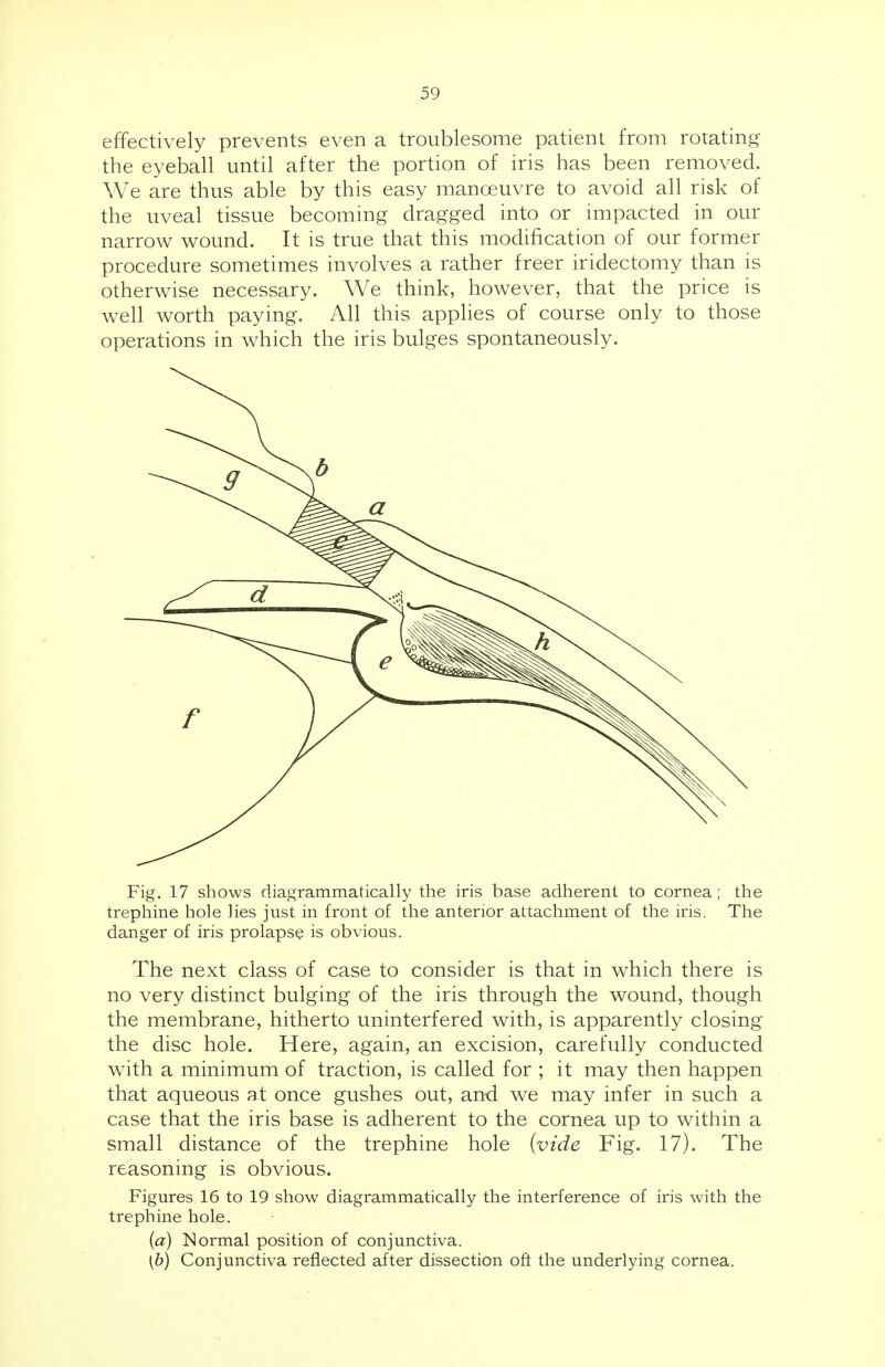 effectively prevents even a troublesome patient from rotating the eyeball until after the portion of iris has been removed. We are thus able by this easy manoeuvre to avoid all risk of the uveal tissue becoming dragged into or impacted in our narrow wound. It is true that this modification of our former procedure sometimes involves a rather freer iridectomy than is otherwise necessary. We think, however, that the price is well worth paying. All this applies of course only to those operations in which the iris bulges spontaneously. Fig. 17 shows diagrammatically the iris base adherent to cornea ; the trephine hole lies just in front of the anterior attachment of the iris. The danger of iris prolapse is obvious. The next class of case to consider is that in which there is no very distinct bulging of the iris through the wound, though the membrane, hitherto uninterfered with, is apparently closing the disc hole. Here, again, an excision, carefully conducted with a minimum of traction, is called for ; it may then happen that aqueous at once gushes out, and we may infer in such a case that the iris base is adherent to the cornea up to within a small distance of the trephine hole (vide Fig. 17). The reasoning is obvious. Figures 16 to 19 show diagrammatically the interference of iris with the trephine hole. (a) Normal position of conjunctiva. (6) Conjunctiva reflected after dissection oft the underlying cornea.