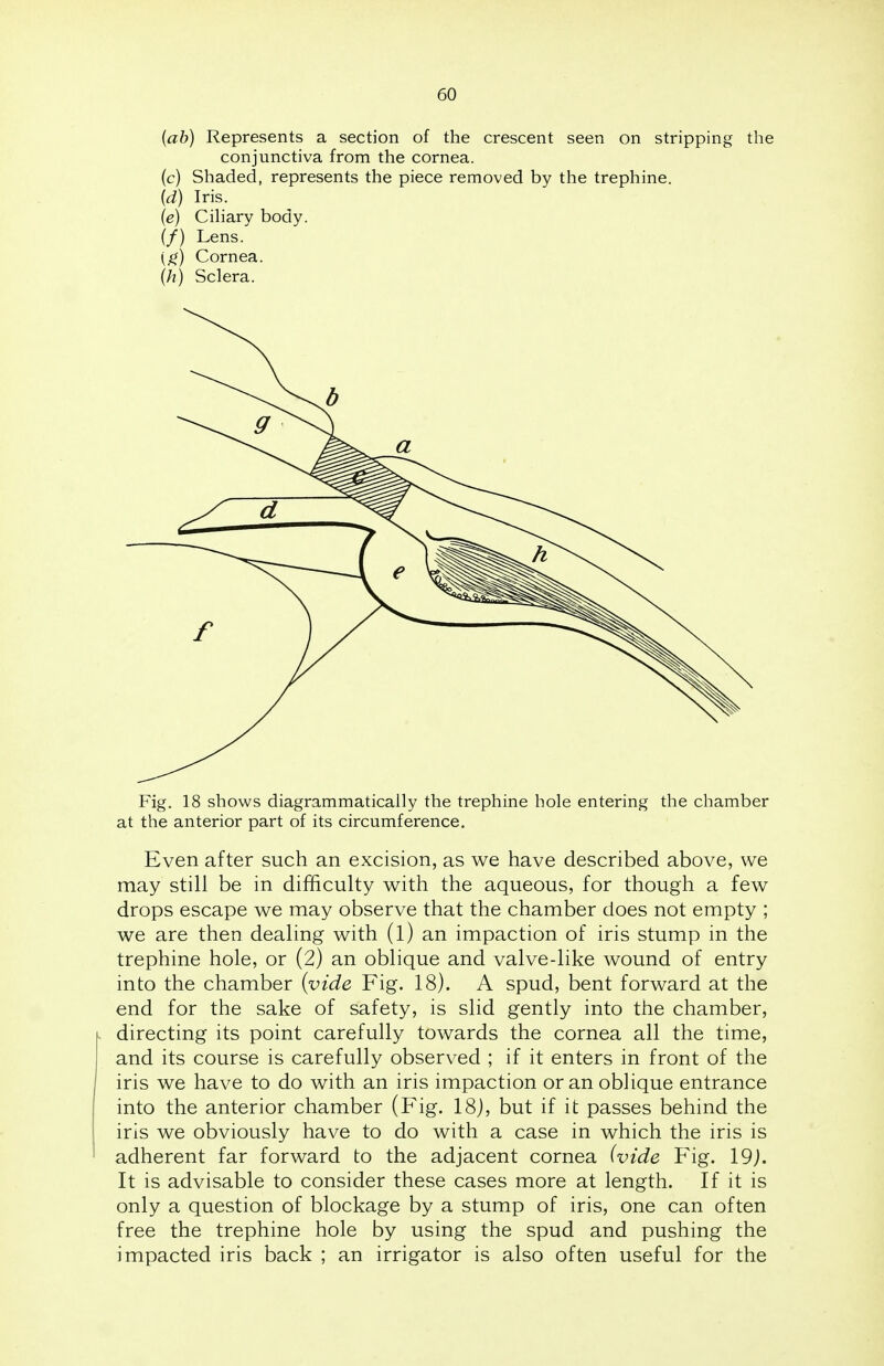 (ab) Represents a section of the crescent seen on stripping the conjunctiva from the cornea. (c) Shaded, represents the piece removed by the trephine. (d) Iris. (e) Ciliary body. (/) Lens. {g) Cornea. (h) Sclera. Fig. 18 shows diagrammatically the trephine hole entering the chamber at the anterior part of its circumference. Even after such an excision, as we have described above, we may still be in difficulty with the aqueous, for though a few drops escape we may observe that the chamber does not empty ; we are then dealing with (l) an impaction of iris stump in the trephine hole, or (2) an oblique and valve-like wound of entry into the chamber {vide Fig. 18). A spud, bent forward at the end for the sake of safety, is slid gently into the chamber, directing its point carefully towards the cornea all the time, and its course is carefully observed ; if it enters in front of the iris we have to do with an iris impaction or an oblique entrance into the anterior chamber (Fig. 18), but if it passes behind the iris we obviously have to do with a case in which the iris is adherent far forward to the adjacent cornea (vide Fig. 19j. It is advisable to consider these cases more at length. If it is only a question of blockage by a stump of iris, one can often free the trephine hole by using the spud and pushing the impacted iris back ; an irrigator is also often useful for the