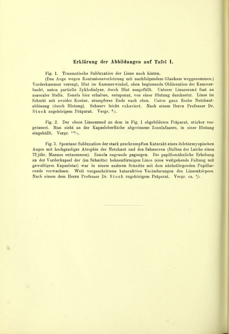 Fig. 1. Trauraatische Subluxation der Linse nach hinten. (Das Auge wegen Kontusionsverletzung mit nachfolgendem Glaukom weggenommen.) Vorderkammer verengt, i31ut im Kammerwinkel, oben beginnende Obliteration der Kammer- bucht, unten partielle Zyklodialyse, durch Blut ausgefüllt. Unterer Linsenrand fast an normaler Stelle. Zonula hier erhalten, entspannt, von einer Blutung durchsetzt. Linse im Schnitt mit ovoider Kontur, stumpferes Ende nach oben. Unten ganz flache Netzhaut- ablösung (durch Blutung). Sehnerv leicht exkaviert. Nach einem Herrn Professor Dr. Stock zugehörigem Präparat. Vergr. '/i. Fig. 2. Der obere Linsenrand an dem in Fig. 1 abgebildeten Präparat, stärker ver- grössert. Man sieht an der Kapseloberfläche abgerissene Zonulafasern, in einer Blutung eingehüllt. Vergr. ^^V« Fig. 3. Spontane Subluxation der stark geschrumpften Katarakt eines deletärmyopischen Auges mit hochgradiger Atrophie der Netzhaut und des Sehnerven (Bulbus der Leiche eines 72jähr. Mannes entnommen). Zonula zugrunde gegangen. Die papillomähnliche Erhebung an der Vorderkapsel der (im Schnitte) bohnenförmigen Linse (eine weitgehende Faltung mit gewaltigem Kapselstar) war in einem anderen Schnitte mit dem nächstliegenden Pupillar- rande verwachsen. Weit vorgeschrittene kataraktöse Veränderungen des Linsenkörpers. Nach einem dem Herrn Professor Dr. Stock zugehörigem Präparat. Vergr. ca. Yi.