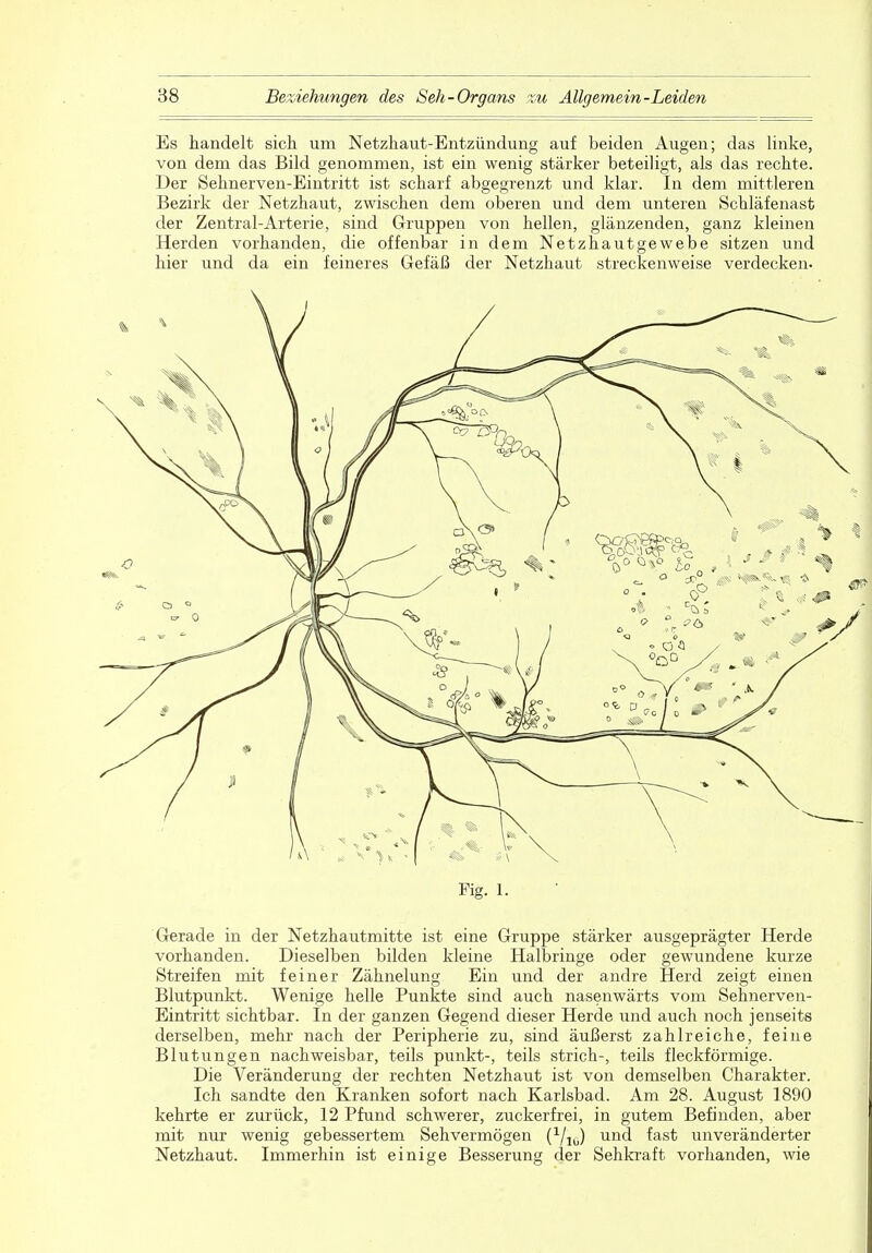 Es handelt sich um Netzhaut-Entzündung auf beiden Augen; das linke, von dem das Bild genommen, ist ein wenig stärker beteiligt, als das rechte. Der Sehnerven-Eintritt ist scharf abgegrenzt und klar. In dem mittleren Bezirk der Netzhaut, zwischen dem oberen und dem unteren Schläfenast der Zentral-Arterie, sind Gruppen von hellen, glänzenden, ganz kleinen Herden vorhanden, die offenbar in dem Netzhautgewebe sitzen und hier und da ein feineres Gefäß der Netzhaut streckenweise verdecken- Fig. 1. Gerade in der Netzhautmitte ist eine Gruppe stärker ausgeprägter Herde vorhanden. Dieselben bilden kleine Halbringe oder gewundene kurze Streifen mit feiner Zähnelung Ein und der andre Herd zeigt einen Blutpunkt. Wenige helle Punkte sind auch nasenwärts vom Sehnerven- Eintritt sichtbar. In der ganzen Gegend dieser Herde und auch noch jenseits derselben, mehr nach der Peripherie zu, sind äußerst zahlreiche, feine Blutungen nachweisbar, teils punkt-, teils strich-, teils fleckförmige. Die Veränderung der rechten Netzhaut ist von demselben Charakter. Ich sandte den Kranken sofort nach Karlsbad. Am 28. August 1890 kehrte er zurück, 12 Pfund schwerer, zuckerfrei, in gutem Befinden, aber mit nur wenig gebessertem Sehvermögen (1/lu) und fast unveränderter Netzhaut. Immerhin ist einige Besserung der Sehkraft vorhanden, wie