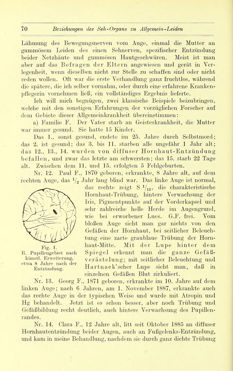 Lähmung des Bewegungsnerven vom Auge, einmal die Mutter an gummösem Leiden des einen Sehnerven, spezifischer Entzündung beider Netzhäute und gummösen Hautgeschwüren. Meist ist man aber auf das Befragen der Eltern angewiesen und gerät in Ver- legenheit, wenn dieselben nicht zur Stelle zu schaffen sind oder nicht reden wollen. Oft war die erste Verhandlung ganz fruchtlos, während die spätere, die ich selber vornahm, oder durch eine erfahrene Kranken- pflegerin vornehmen ließ, ein vollständiges Ergebnis lieferte. Ich will mich begnügen, zwei klassische Beispiele beizubringen, welche mit den sonstigen Erfahrungen der vorzüglichen Forscher auf dem Gebiete dieser Allgemeinkrankheit übereinstimmen: a) Familie F. Der Vater starb an Geisteskrankheit, die Mutter war immer gesund. Sie hatte 15 Kinder. Das 1., sonst gesund, endete im 25. Jahre durch Selbstmord; das 2. ist gesund; das 3. bis 11. starben alle ungefähr 1 Jahr alt; das 12., 13., 14. wurden von diffuser Hornhaut-Entzündung befallen, und zwar das letzte am schwersten; das 15. starb 22 Tage alt. Zwischen dem 11. und 15. erfolgten 5 Fehlgeburten. Nr. 12. Paul F., 1870 geboren, erkrankte, 8 Jahre alt, auf dem rechten Auge, das 1j2 Jahr lang blind war. Das linke Auge ist normal, das rechte zeigt S 1/12, die charakteristische Hornhaut-Trübung, hintere Verwachsung der Iris, Pigmentpunkte auf der Vorderkapsel und sehr zahlreiche helle Herde im Augengrund, wie bei erworbener Lues. G.F. frei. Vom bloßen Auge sieht man gar nichts von den Gefäßen der Hornhaut, bei seitlicher Beleuch- tung eine zarte graublaue Trübung der Horn- Fig haut-Mitte. Mit der Lupe hinter dem R. Pupillengebiet nach Spiegel erkennt man die ganze Gefäß- kunstl. Erweiterung, Verästelung; mit seitlicher Beleuchtung und etwa 8 Jahre nach der TT . , , . T . , . -, n Entzündung. Hartnack scher Lupe sieht man, daß m einzelnen Gefäßen Blut zirkuliert. Nr. 13. Georg F., 1871 geboren, erkrankte im 10. Jahre auf dem linken Auge; nach 6 Jahren, am 1. November 1887, erkrankte auch das rechte Auge in der typischen Weise und wurde mit Atropin und Hg behandelt. Jetzt ist es schon besser, aber noch Trübung und Gefäßbildung recht deutlich, auch hintere Verwachsung des Pupillen- randes. Nr. 14. Clara F., 12 Jahre alt, litt seit Oktober 1885 an diffuser Hornhautentzündung beider Augen, auch an Fußgelenks-Entzündung, und kam in meine Behandlung, nachdem sie durch ganz dichte Trübimg