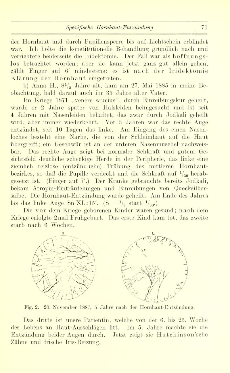 der Hornhaut und durch Pupillensperre bis auf Lichtschein erblindet war. Ich holte die konstitutionelle Behandlung gründlich nach und verrichtete beiderseits die Iridektomie. Der Fall war als hoffnungs- los betrachtet worden; aber sie kann jetzt ganz gut allein gehen, zählt Finger auf 6' mindestens: es ist nach der Iridektomie Klärung der Hornhaut eingetreten. b) Anna H, S1^ Jahre alt, kam am 27. Mai 1885 in meine Be- obachtung, bald darauf auch ihr 35 Jahre alter Vater. Im Kriege 1871 „venere saucius, durch Einreibungskur geheilt, wurde er 2 Jahre später von Halsleiden heimgesucht und ist seit 4 Jahren mit Nasenleiden behaftet, das zwar (buch Jodkali geheilt wird, aber immer wiederkehrt. Vor 3 Jahren war das rechte Auge entzündet, seit 10 Tagen das linke. Am Eingang des einen Nasen- loches besteht eine Narbe, die von der Schleimhaut auf die Haut übergreift; ein Geschwür ist an der unteren Nasenmuschel nachweis- bar. Das rechte Auge zeigt bei normaler Sehkraft und gutem Ge- sichtsfeld deutliche scheckige Herde in der Peripherie, das linke eine ziemlich reizlose (entzündliche) Trübung des mittleren Hornhaut- bezirkes, so daß die Pupille verdeckt und die Sehkraft auf 1/30 herab- gesetzt ist. (Finger auf 7'.) Der Kranke gebrauchte bereits Jodkali, bekam Atropin-Einträufehmgen und Einreibungen von Quecksilber- salbe. Die Hornhaut-Entzündung wurde geheilt. Am Ende des Jahres las das linke Auge SnXL:15'. (S = 1/3 statt 1/30.) Die vor dem Kriege geborenen Kinder waren gesund; nach dem Kriege erfolgte 2mal Frühgeburt. Das erste Kind kam tot, das zweite starb nach 6 Wochen. Fig. 2. 20. November 1887, 5 Jahre nach der Hornhaut-Entzündung. Das dritte ist unsre Patientin, welche von der 6. bis 25. Woche des Lebens an Haut-Ausschlägen litt. Im 5. Jahre machte sie die Entzündung beider Augen durch. Jetzt zeigt sie Hutchinson'sche Zähne und frische Iris-Keizung. R L