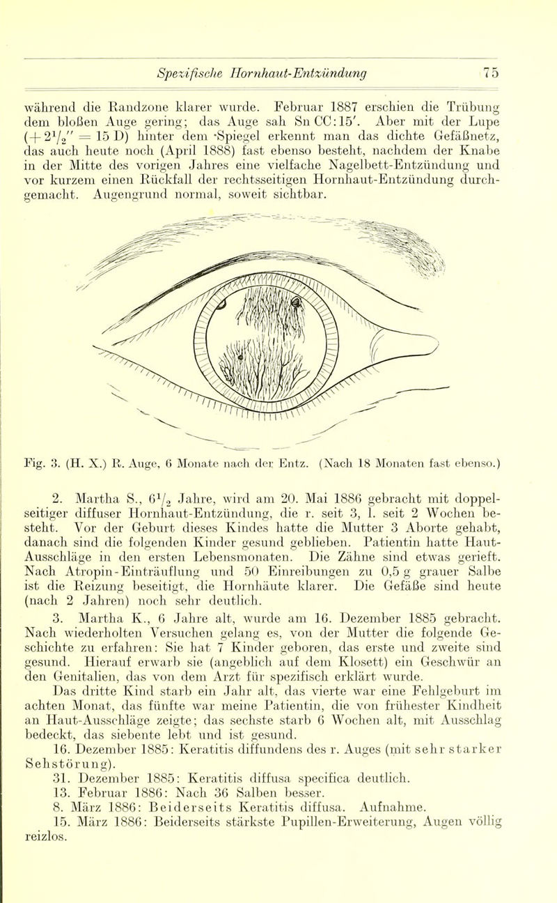 während die Randzone klarer wurde. Februar 1887 erschien die Trübung dem bloßen Auge gering; das Auge sah SnCC:15'. Aber mit der Lupe (+21/2 = 15 D) hinter dem Spiegel erkennt man das dichte Gefäßnetz, das auch heute noch (April 1888) fast ebenso besteht, nachdem der Knabe in der Mitte des vorigen Jahres eine vielfache Nagelbett-Entzündung und vor kurzem einen Rückfall der rechtsseitigen Hornhaut-Entzündung durch- gemacht. Augengrund normal, soweit sichtbar. Fig. 3. (H. X.) R. Auge, 6 Monate nach der Entz. (Nach 18 Monaten fast ebenso.) 2. Martha S., G1^ Jahre, wird am 20. Mai 1886 gebracht mit doppel- seitiger diffuser Hornhaut-Entzündung, die r. seit 3, 1. seit 2 Wochen be- steht. Vor der Geburt dieses Kindes hatte die Mutter 3 Aborte gehabt, danach sind die folgenden Kinder gesund geblieben. Patientin hatte Haut- Ausschläge in den ersten Lebensmonaten. Die Zähne sind etwas gerieft. Nach Atropin-Einträuflung und 50 Einreibungen zu 0,5 g grauer Salbe ist die Reizung beseitigt, die Hornhäute klarer. Die Gefäße sind heute (nach 2 Jahren) noch sehr deutlich. 3. Martha K., 6 Jahre alt, wurde am 16. Dezember 1885 gebracht. Nach wiederholten Versuchen gelang es, von der Mutter die folgende Ge- schichte zu erfahren: Sie hat 7 Kinder geboren, das erste und zweite sind gesund. Hierauf erwarb sie (angeblich auf dem Klosett) ein Geschwür an den Genitalien, das von dem Arzt für spezifisch erklärt wurde. Das dritte Kind starb ein Jahr alt, das vierte war eine Fehlgeburt im achten Monat, das fünfte war meine Patientin, die von frühester Kindheit an Haut-Ausschläge zeigte; das sechste starb 6 Wochen alt, mit Ausschlag bedeckt, das siebente lebt und ist gesund. 16. Dezember 1885: Keratitis diffundens des r. Auges (mit sehr starker Sehstörung). 31. Dezember 1885: Keratitis diffusa specifica deutlich. 13. Februar 1886: Nach 36 Salben besser. 8. März 1886: Beiderseits Keratitis diffusa. Aufnahme. 15. März 1886: Beiderseits stärkste Pupillen-Erweiterung, Augen völlig reizlos.